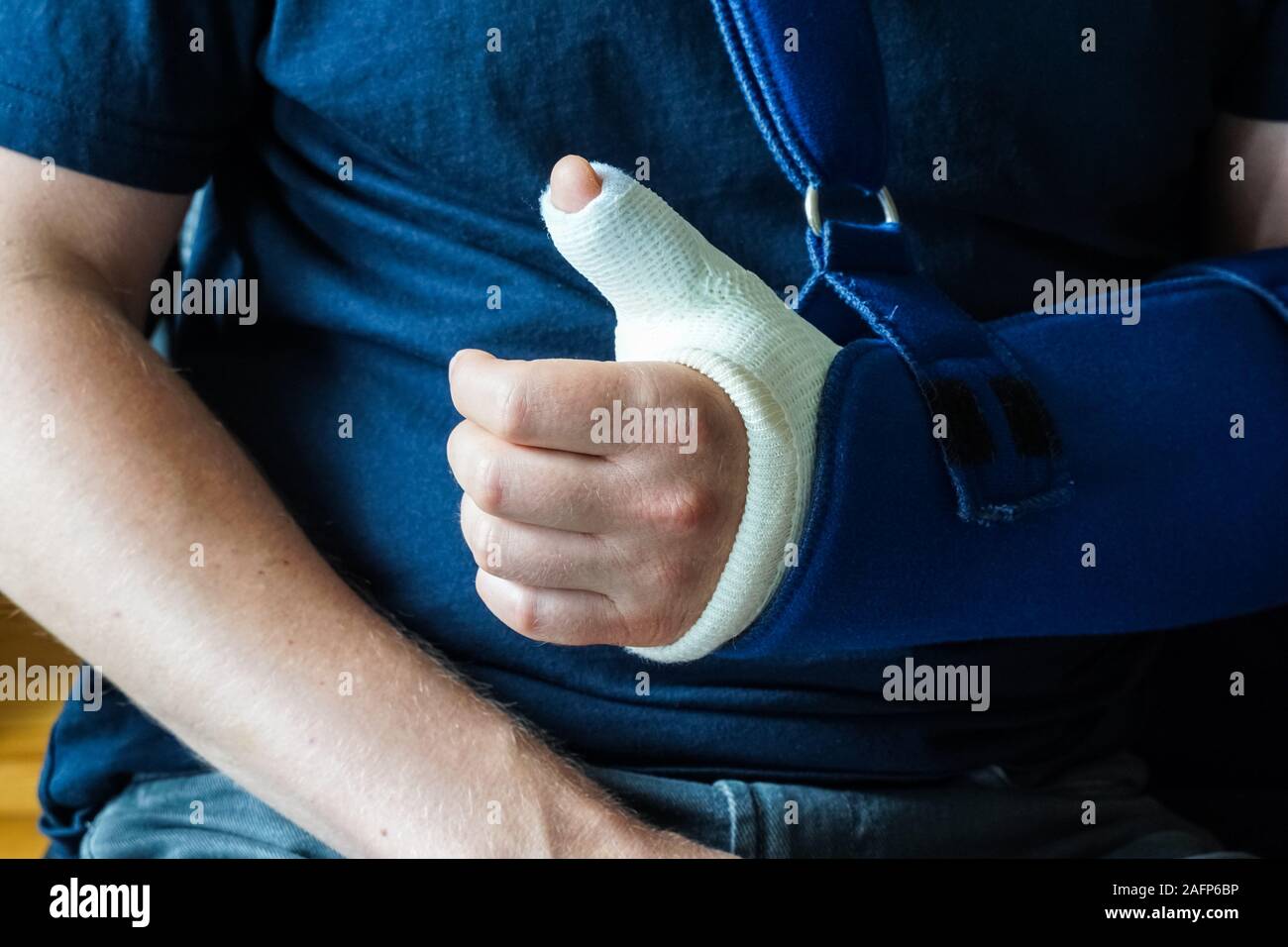 Uomo con il calco in gesso sul pollice rotto,rotture di polso e mano rotti sul braccio imbracatura Foto Stock