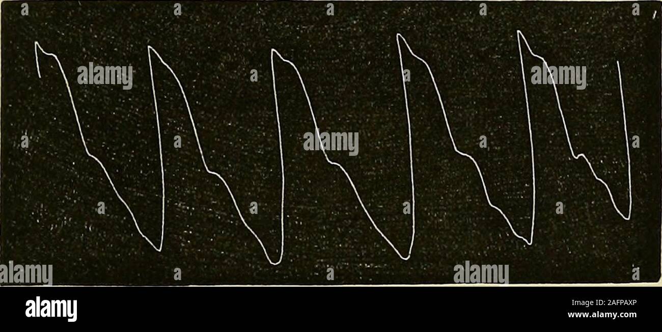 . Le malattie del cuore e aorta toracica. Fig. 2-)0.-Sphygmographic tracing da un caso di malattia mitrale, dopo theadministration di digitalis. Il cuore è stato molto ipertrofiche ; il polso era intermittente, ciascuna delle curve thepulse mostrato nella figura occupa il tempo di due normali cardiacrevolutions. I caratteri speciali di impulso in aortica e mitrale sono lesioni describedon pagine 444, 492, 513, e 525. Ipertrofia del rig ventricolo JIT. 597 navi (se saldamente, contratta ateromatose, ecc.) ; thetidal onda è di solito molto prominente e la pressione sistolica partedell tracing m Foto Stock