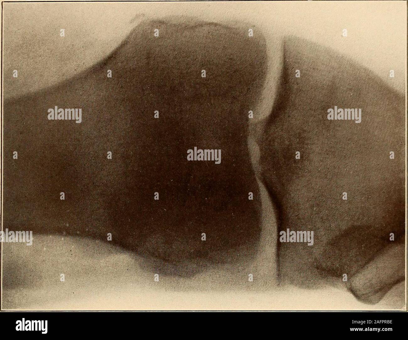 . Una pratica Treatise on fratture e dislocazioni. Piastra XXll. Fig. 1.-frattura della Epieondyle interna del Feniur. Fie]. 2. Frattura del Tiiberoi esterno^ity oltlie Foiuur fratture del femore. Condilo 407 ; sia seguita a soffiare sul ginocchio e la skiagram era takenpromptly. Alcuni dei casi segnalati sono senza dubbio le fratture,ma anche quelli in cui la skiagrams sono state adottate solo dopo l'lapseof poche settimane sono dubbie. E. frattura della tuberosità esterna. Ho visto un caso di frattura della tuberosità esterna, apparentlyby avulsione attraverso il legamento laterale. Foto Stock
