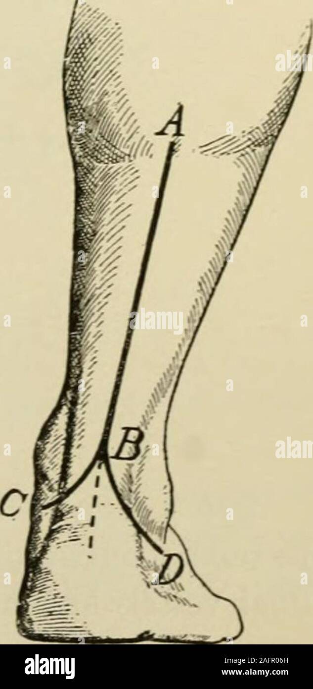 . Manuale di intervento chirurgico. Fig. 1546.-tendine di trapianto. {Berger aftd Banzet.) L.P., Peroneus longus. t.a.. Il tendine AchiUis. C.P.. Peroneus brevis. i. Porzione integra il tendine peroneuslongus. 2. Aletta da peroneus longus. 3. Aletta da tendo AchiUis. Fase 4.-Split il tendine in forma esterna ed interna del segmento. Lasciare il segmento theouter intatto. Dividere il tratto interno trasversalmente, bassa downbelow del malleolo, così da formare un lembo con la sua pedicleabove. Fase 5.-mettere il piede in una posizione di equinus andhold lì. Posare i due lembi di tessuto tipo tendine (da theperoneus longus e dalla tendo AchiUis) Foto Stock