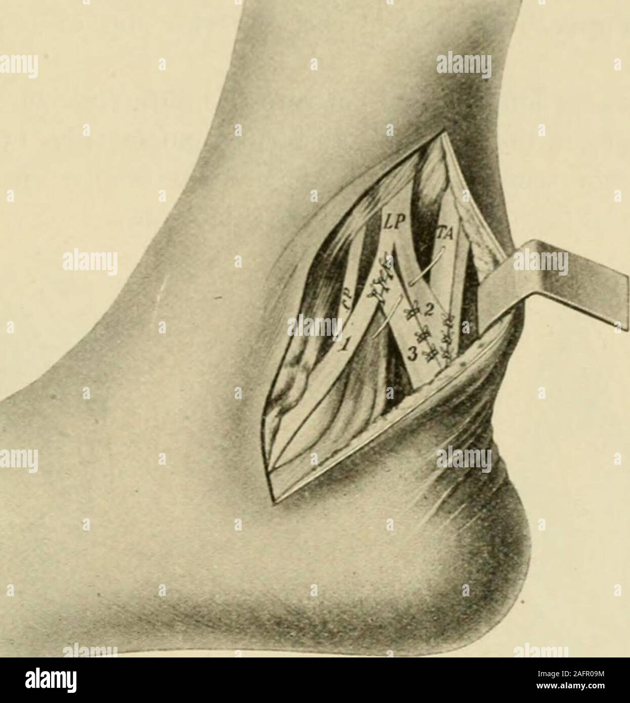 . Manuale di chirurgia operativa. i pollici lungo-libero al di sopra, uniti al os calcisbelow. Il tendine TRAXSILANTATIUN MI213 passo 3.-incidere la fascia profonda parallela e vicino alla parte posteriore borderof perone. Esporre e aprire la guaina dei muscoli peronei. Thetendon del p. longus giace posteriore a quella del brevis. Fig. 1546.. Fig. 1546.-tendine di trapianto. {Berger aftd Banzet.) L.P., Peroneus longus. t.a.. Il tendine AchiUis. C.P.. Peroneus brevis. i. Porzione integra il tendine peroneuslongus. 2. Aletta da peroneus longus. 3. Aletta da tendo AchiUis. Fase 4.-Split il tendine in una superficie esterna ed in Foto Stock