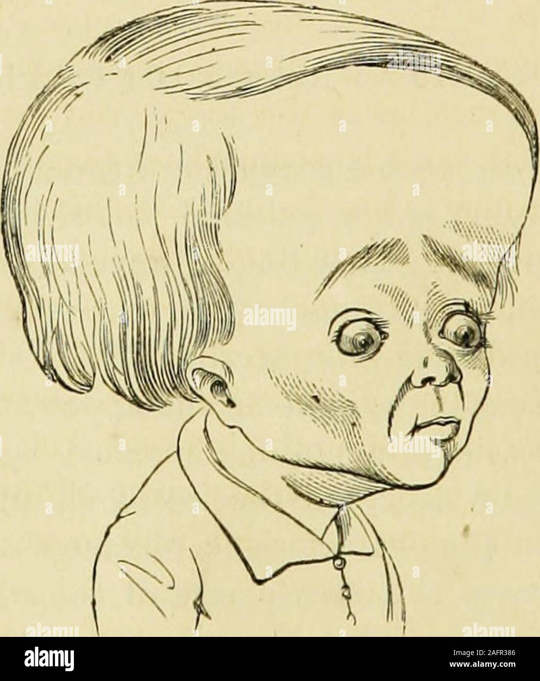 . Un trattato sulle malattie dell'infanzia e della fanciullezza. antity del fluido è più thansufficient per fornire la carenza. Caratteri anatomici.-Secondo M. Breschet thefluid in idrocefalo congenito può essere, 1st, tra la duramater e il cranio; 2d, tra la dura madre e la parie-tal arachnoid; 3d, nella cavità della arachnoid; 4th, in theventricles; 5th, tra la arachnoid e il cervello. In una grande maggioranza di pazienti hydrocephalic la sede di theeffusion è i ventricoli. Come la quantità di fluido aumenta, lapressione dall'interno si dispiega gradualmente le circonvoluzioni dell Foto Stock