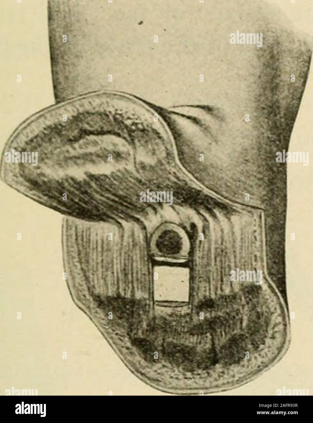 . Manuale di intervento chirurgico. 4 pollici. Dividere la tibia con una sega Gigli (Fig. 1462, A). Separare le parti molli dalla tibia verso il basso. Esporre la fibulanear il livello esterno dell'ovale incisione di pelle. Dividere il periosteo fibular amputazioni OSTEOPLASTIC 1179 (Fig. 1462, b) e spingerla verso l'alto in modo da formare un bracciale. Dividere la fibula(Fig. 1462, B). Fase 3 - Scegliere un punto sulla fibula vicino al livello dei segati in superficie del. Foto Stock