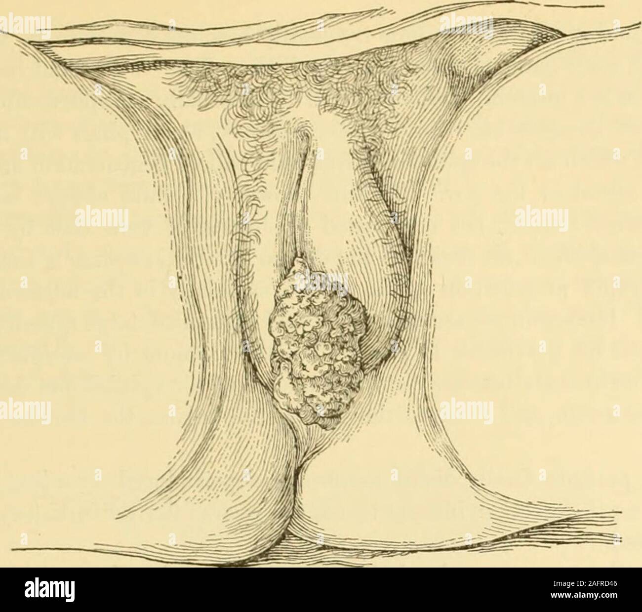 Gyncology clinici, medici e chirurgici. ing attacchi di vulvite può portare  ad esso.un eczema cronico leader; ad un addensamento; della mucosa della  labia inscattered patch, il cosiddetto kraurosis di Breisky, è