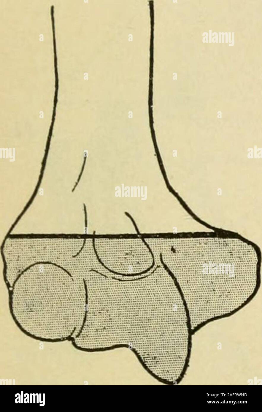 . Manuale di intervento chirurgico. Fig. 1376.-artroplastica,metodo autori. Gomito di artroplastica III9 4. Resecare il olecranon alla sua base. La moda dell'osso come mostrato nelle Figg.1378 e 1379. Resecare la porzione della testa del raggio che projectsabove la superficie segato dell'ulna. Se anchylosis esiste tra il radiusand ulna separare queste ossa con una bella punta a scalpello. 5. Staccare gli elastici di constrictor. Partecipare per emostasi con la solita cautela. 6. Interposizione di muscolo.-(a) Flex l'avambraccio acutamente. Dividere theanterior capsula articolare trasversalmente in corrispondenza della sua inserzione ulnare; continuare thisincision in th Foto Stock