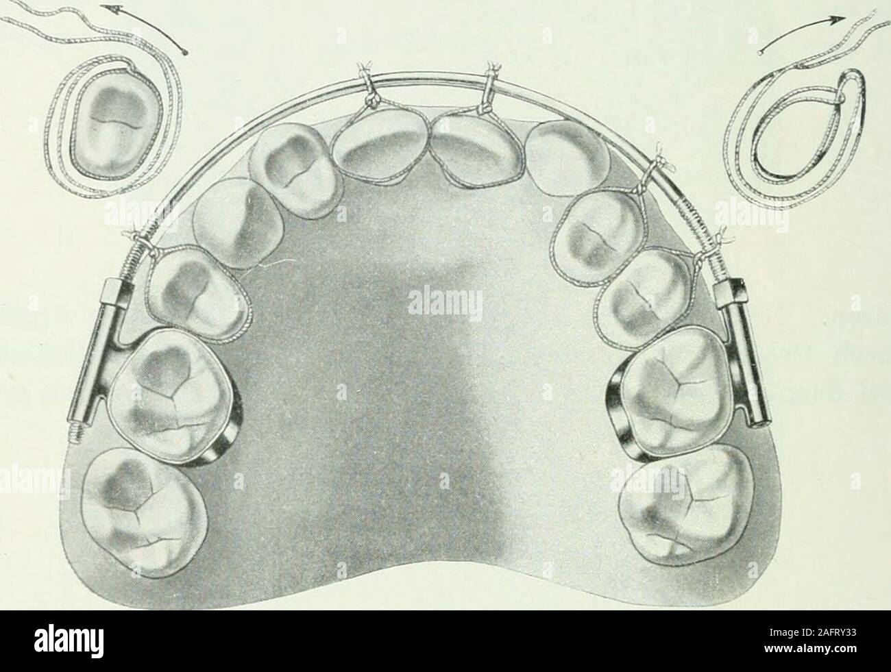 . Lehrbuch der orthodontie fur studierende und zahnartze enschluss mit der Geschichte der orthodontie. Fig. 219. schoben durch auswärts angebrachte Schrauben, die in der kleinenKanülen Eckzahnbänder ihren Halt fanden. Durch den einenan Schneidezähnen entlang gehenden Verbindungsbügel derEckzähne waren die Zähne zwischenliegenden gezwungen, un 15* 228 II. Therapie der Anomalien. der Vorwärtsbewegung teilzunehmen. 218 Abbildung zeigt denimten Apparat. Wie die Prämolaren durch einen Dehnungsapparat einfach-ster forma nach außen in den normalen Zahnbogen hineinge-drängt werden, illustriert die Abbi Foto Stock