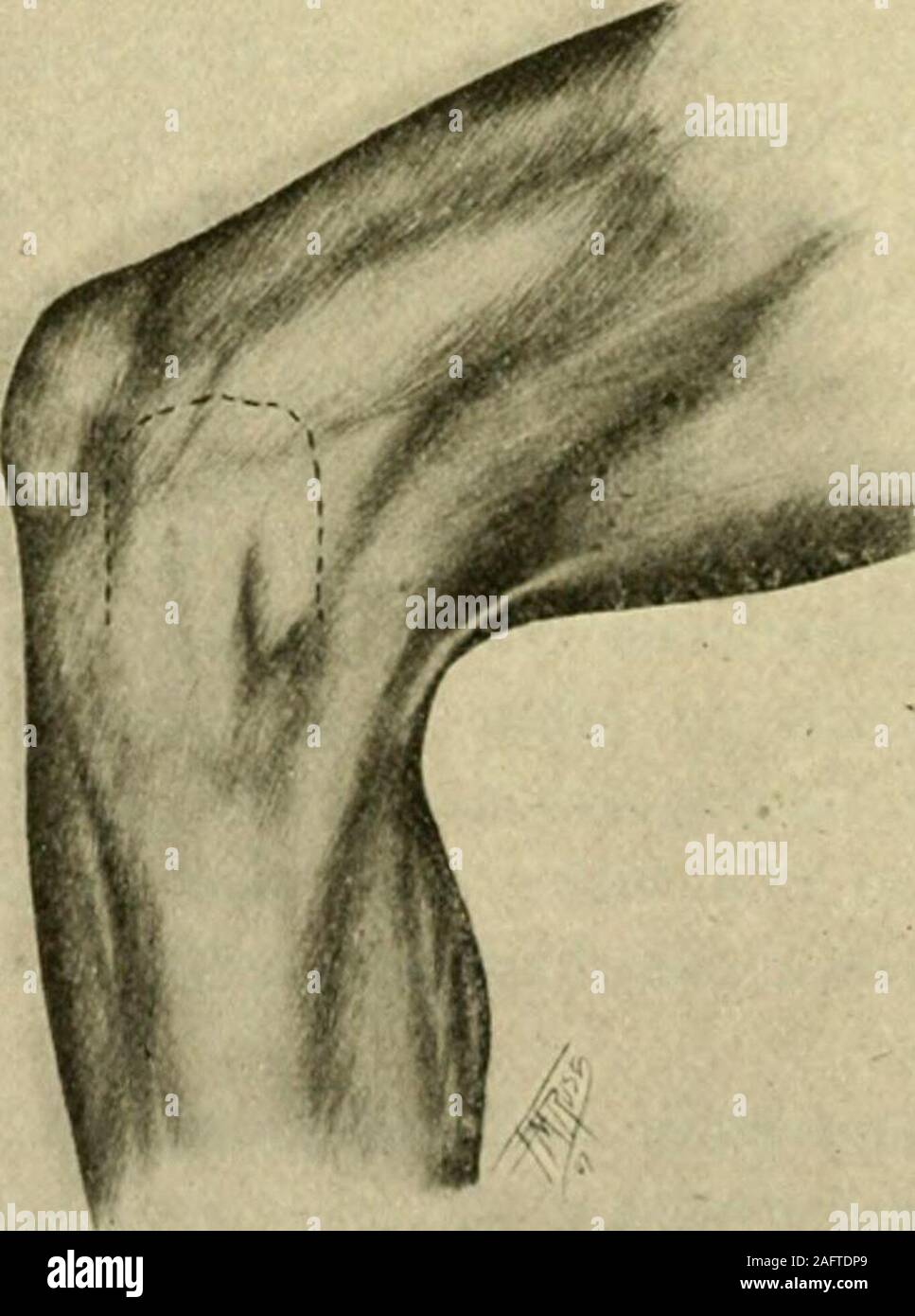. Manuale di intervento chirurgico. Fig. 1281.. Fig. 1282.-{Freeman.) INTERNA CONFUSIONALI IO33 qui necessario. In muscoli gastrocnemei ci sono spesso presenti smalsesamoid ossa (Fig. 1281), che possono essere scambiati per organi allentati nel giunto. Semilunar spostata la cartilagine. Confusionali interno dell'articolazione del ginocchio (Hey).-Molti metodi sono stati ideati per esporre un displacedsemilunar cartilagine. Annandale nel 1885 descritto un metodo di ancoraggio thecartilage attraverso una semplice incisione trasversale. Freeman riflette ad U a lembo di tutti i tessuti, compresi la capsula,all'interno o extern Foto Stock