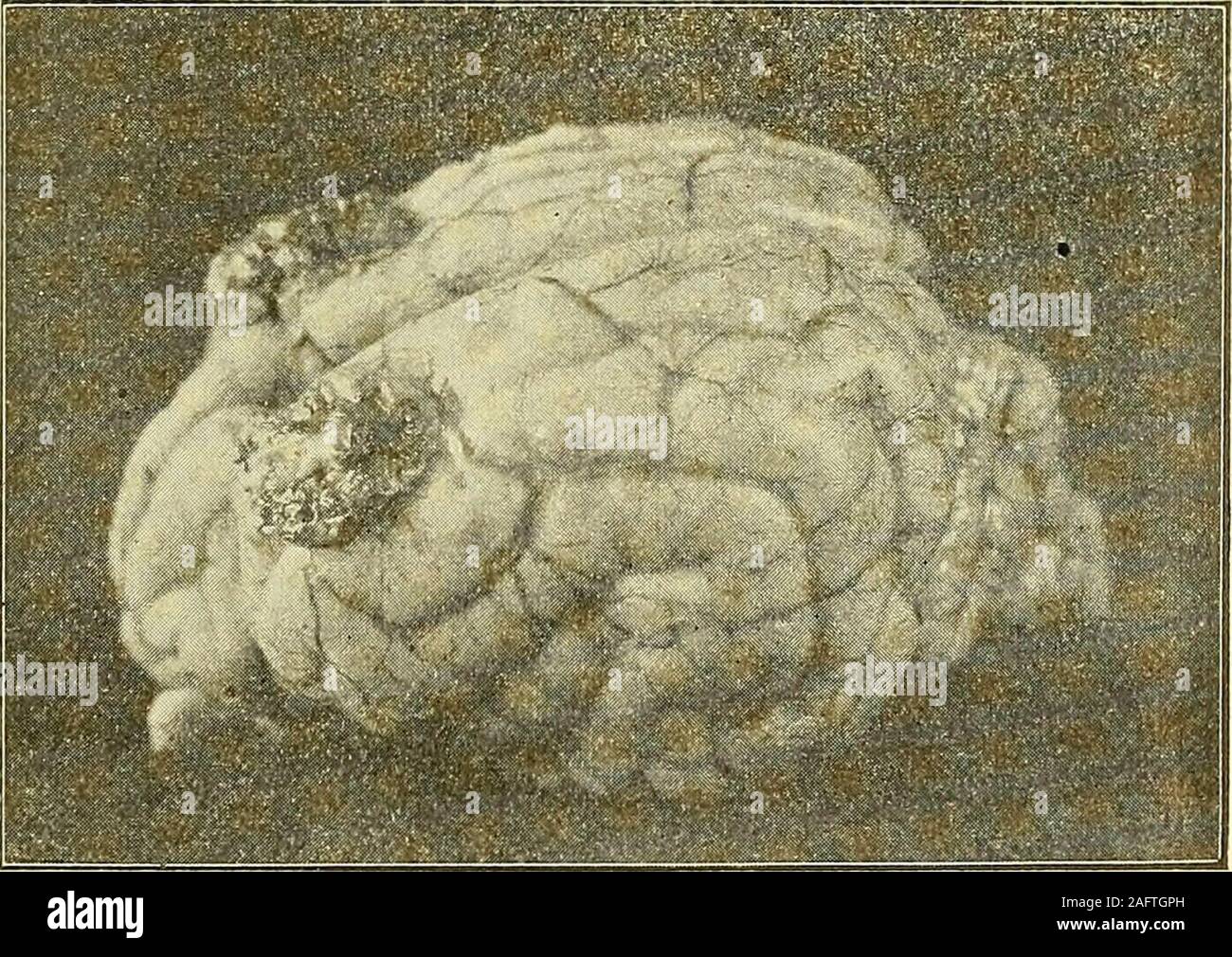 . Physiologische und klinische Untersuchungen über das Gehirn,: gesammelte Abhandlungen. n Hemisphäre ziehen blutig verfärbte Erweichungsstreifenbasalwärts, bis zum oberen Winkel des dort beginnenden Seitenventrikels.2.Durchschnitt 2-3mm hinter hinteren dem Rande der Narbe: oberenTheilder Im inneren Kapsel findet sich ein leicht blutig verfärbter, etwa linsengrosserErweichungsherd, der sie fast völlig durchtrennt und nur und mediale lateralganz schmale Streifen Markweiss lässt intatto. Ein zweiter kleiner mandria findetsich im medialen dorsalen Bezirk des Centrum semiovale. Der Querschnitt,namentlic Foto Stock