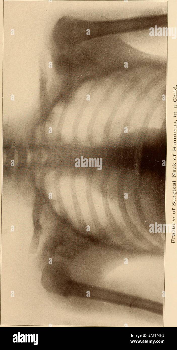 . Una pratica Treatise on fratture e dislocazioni. o a gomito, presumibilmente coadiuvato da theresistance della glenoide fossa o acromion, il cosiddetto ^^ com-pression ^ fratture, ma molto più frequentemente, credo, da una croce-ceppo in cui l'estremità superiore è fi^sso dalla resistenza dei legamenti capsuleand ed eventualmente i muscoli e il gomito è forcedoutward o in avanti o è fissa nel rapimento mentre il colpo è receivedon la parte esterna della spalla, il rapimento di fratture; adductionfractures, dalla violenza che agisce nella direzione opposta, sono molto rari.Il fractur inferiore Foto Stock
