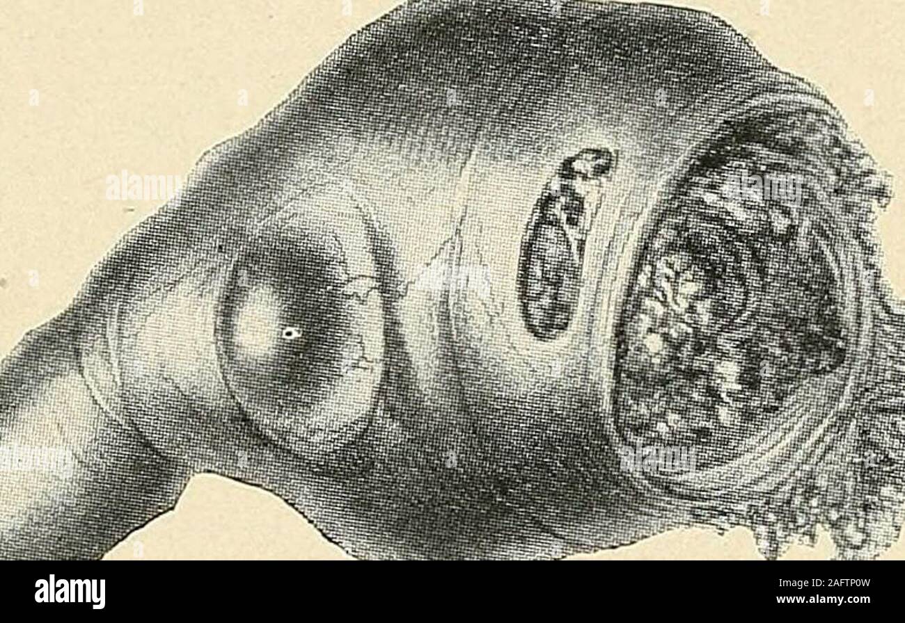 . La diagnosi e il trattamento delle malattie delle donne. Fig. 641. Gravidanza tubarica con intra-peritoneale rottura, show-ing il sangue nella cavità peritoneale, tra le bobine intestinale.(Dickinson-American libro di testo di ostetricia.) 706 gravidanza extrauterina nancy, e quindi presenta maggiori difficoltà nella diagnosi di una gravidanza fartherout nel tubo. Se il luogo di presentazione delle fecondato avviene per essere vicino alla estremità esterna del l'insiemetubo (Fig. 639) il conseguente ampliamento del lume del tubo da sviluppare-ing embrione, apre la estremità del tubo, e l'embrione con le membrane islikely t Foto Stock