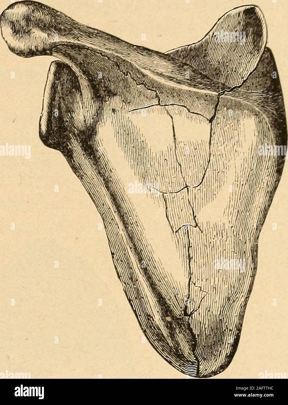 . Una pratica Treatise on fratture e dislocazioni. iece della colonna vertebrale, A. 1 Lane : Guys Hospital Report, 1886, vol. xliii. p. 418. 222 fratture della scapola. 223 Fig. 100. e serratus, mentre lo spostamento laterale è il risultato del con-tinued azione della forza di rottura. In alcuni casi i frammenti haveunited dopo trasversale o frattura obliqua in una posizione tale che theytouch o override in corrispondenza di un lato evengono separati all'altra. In fratture multiple il lesionis estremamente variabile, il fracturemay essere recitato/^ o triturate,alcune delle linee può essere incom-reparti e il principale Foto Stock