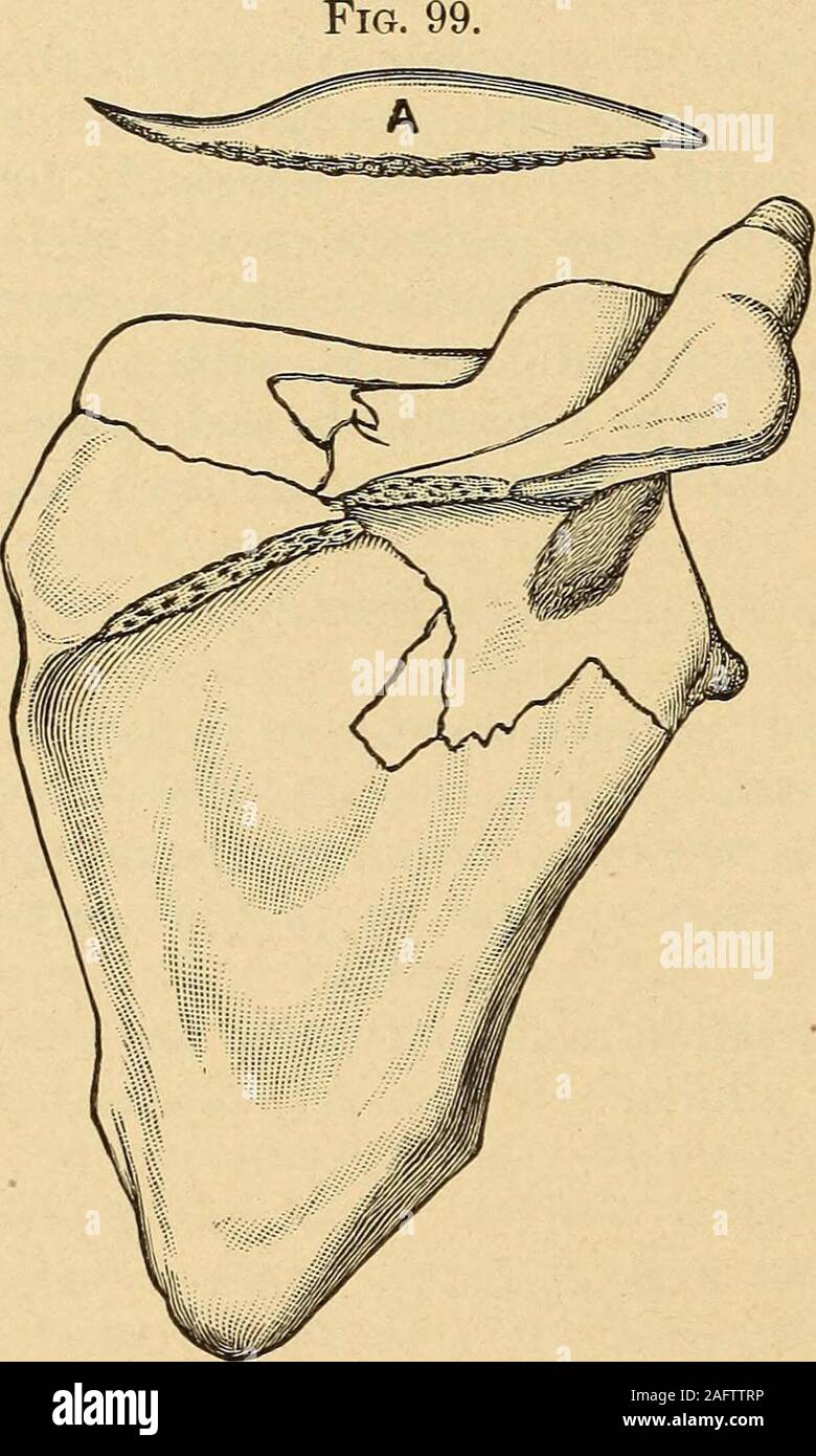 . Una pratica Treatise on fratture e dislocazioni. iter in lasthundred anni hanno fatto da sei gruppi toeight come segue: 1st, frac-tures del corpo; 2d, fratture delcarrello angolo inferiore ; 3d, fratture delcarrello angolo superiore e sovra-spinousfossa ; 4th, fratture della spina dorsale ;5th, fratture di acromion ; 6th,fratture del processo coracoid.;7th, fratture attraverso il surgicalneck; 8th, fratture della cavità glenoidea. Di queste varietà di 1a,4a e 5a sono di gran lunga la più comune; gli altri sono extremelyrare. 1. Le fratture del corpo della scapola. Le fratture del corpo del th Foto Stock