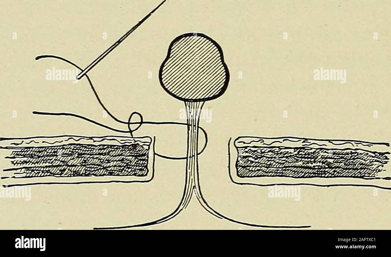 Malattie del retto e dell'ano: progettato per studenti e professionisti  della medicina. mento di successo di un ano artificiale.Questo consiste nel  produrre un tale angtdation dell'intestino chenon è impossibile per le