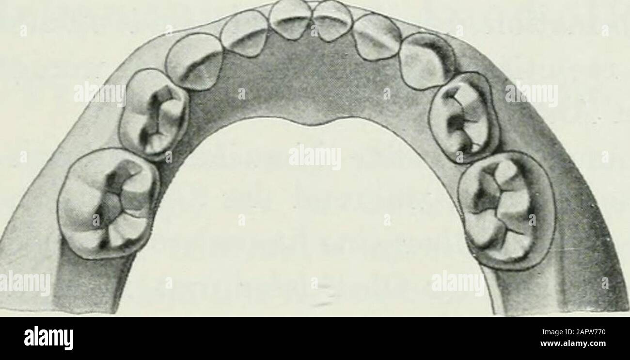 . Lehrbuch der orthodontie fur studierende und zahnartze enschluss mit der Geschichte der orthodontie. Tomi beschriebener caduta,wo infolge von Narbenkontraktur bei ausgedehnter Verbrennungam Halse eine bedeutende Dislokation des Unterkiefers stattfand. Ein exzessives Wachstum des Unterkiefers kann einmal den III. Ätiologie der Stellungsanomalien. 1Q7 Unterkiefer und Alveolarfortsatz betreffen und zweitens die Unter-kieferäste allein, die dann mit dem Kieferkörper einen allzustumpfen Winkel bilden; jedenfalls wird hierbei der Oberkiefer Unterkieferden weit überragen. Außer in einem falle, wo di Foto Stock