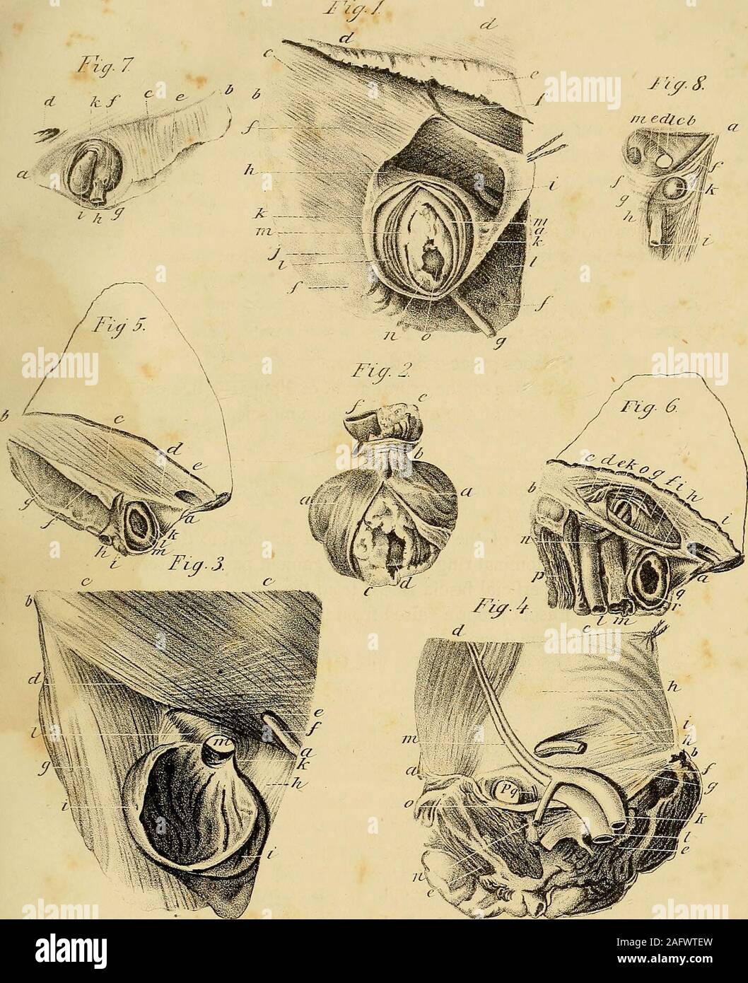 . L'anatomia e il trattamento chirurgico di ernia addominale. gament.dd. Tendine del muscolo obliquo esterno. e. Fascia superficiale sollevato dal muscolo obliquo esterno.ff. Fascia superficiale.g. La vena safena grande vene la fascia superficiale essendo asportate per mostrare it.h. Una parte della fascia superficiale attaccata al ernie crurali arch.i. Anello di addominali e legamento rotondo che passa attraverso di esso.k. Fascia superficiale sollevato dall'ernia.//. Scudo propria sollevata da erniaria sac.m m. Erniaria sac. n. Omento entro il erniaria sac.o. Intestino entro il erniaria sac. Fig. 2. Mostra la forma e il contenuto Foto Stock