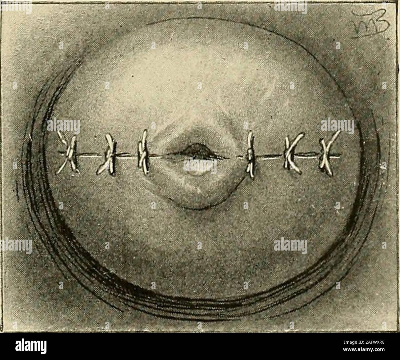 . La diagnosi e il trattamento delle malattie delle donne. Fig. 557. Il disboscamento completato e suture passata su un lato.(J&lt;ielly-Ope]-ative Gynecolofjy.). Fig. 558. Suture legata - OPERAZIONECOMPLETED. (Kelly- operativo Gyne-cology.) . In questa operazione, per mantenere il fieldclear di b 1 o o d, impiego spugnatura con 556 le malattie dell'utero cotone-sfere strizzato di soluzione bichloride (1-5000) e mantenuta a lungo il forcipe,con lavaggi saltuari fuori con il caldo bichloride soluzione. Se preferite, con-tinuous irrigazione può essere impiegato, con occasionali spugnatura. Per il materiale di sutura nella cervice, ho Foto Stock