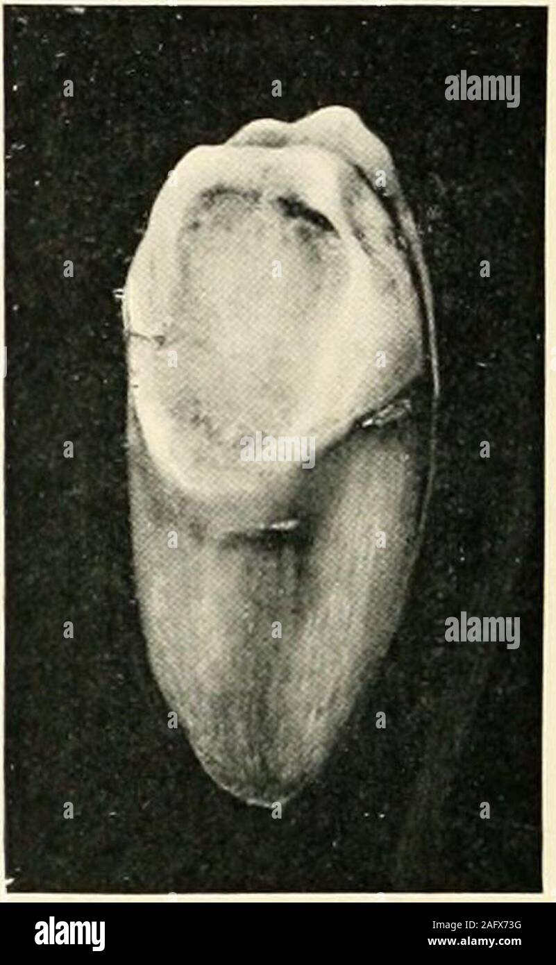 . La scienza e la pratica della chirurgia dentale. Fig. 983.-una sezione di geminati compositeodontome. {Da una camera lucida disegno byD. P. Gabell.) {iluseum del Royal DentalHospital di Londra.) Le radici di molari tlie appaiono distinti. La massa complexcalcified è strettamente collegato al dente. E smalto. D, la dentina. C Cementimi. M, Irregu-larly materiale calcificato. probabilmente bisogno di attenzione solo se essi sono di dsupporto grande dimensione. 4. Gestant Odontomes composito Gestant conijiosite odontomes sono quelle com-posite odontomes in cui un denticle è containedwithin, o circondato dalle mura di un dente. T Foto Stock