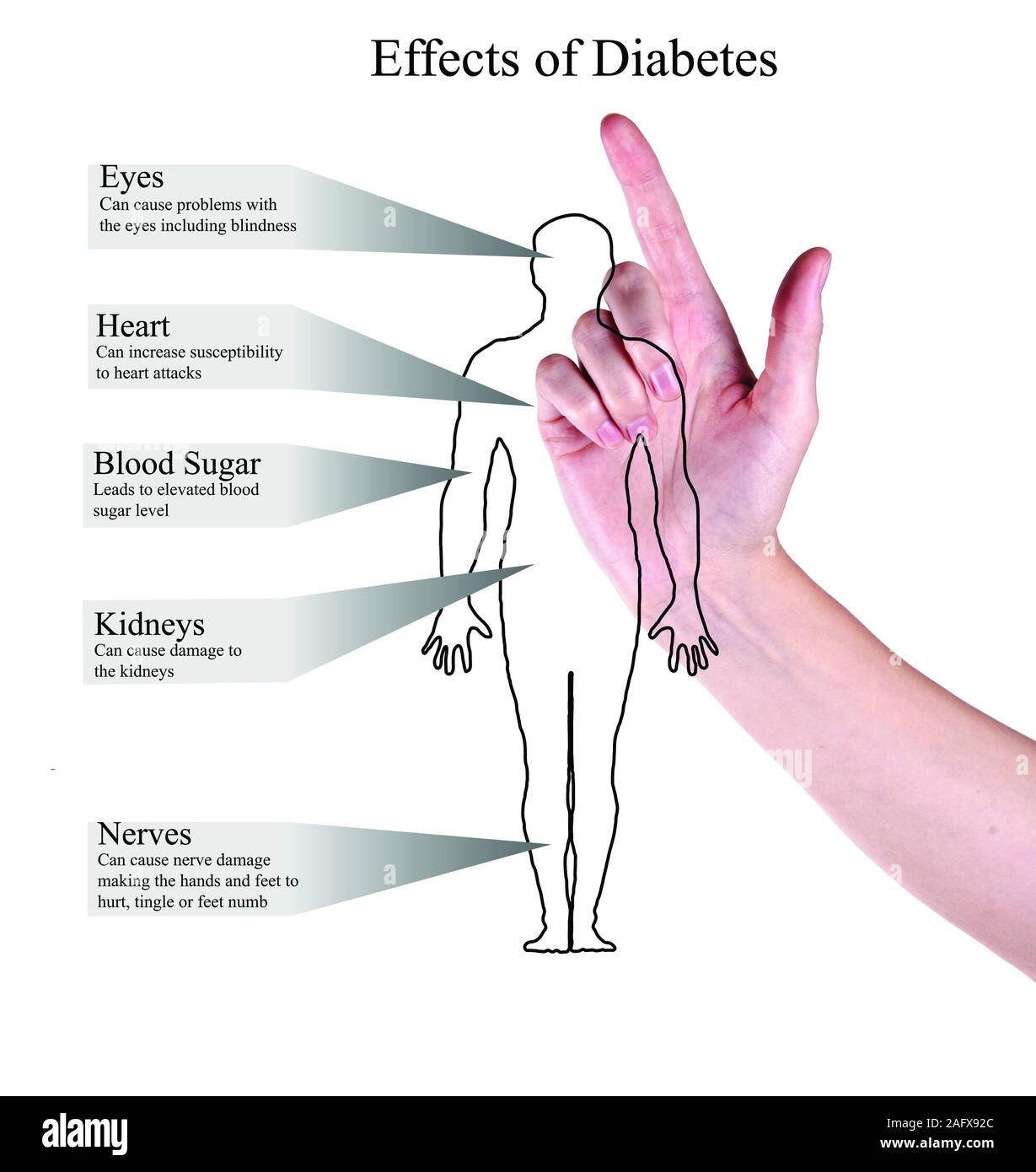 Effetti del diabete Foto Stock