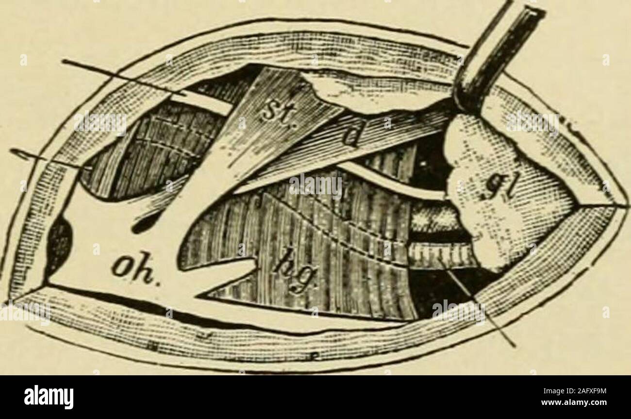 . Manuale di chirurgia operativa. una incisione parallela alla edal i^ pollici sopra il gran corno dell'hyoid. Dividere la pelle e theplatysma. Dividere la fascia profonda. Legare e dividere o ritrarre qualsiasi veinswhich venite nel modo. Passo 2.-ritrarre il premistoppa sottomascellari verso l'alto (Fig. 1003). Esporre theposterior ventre della digastric sotto il quale si trova il nervo ipoglosso. Thenerve costituisce una buona guida per il muscolo hyoglossus su cui esso giace. Vena Thelingual può trovarsi sia esso superficiale al hyoglossus o al di sotto di esso lungo conl'arteria. Per evitare lesioni al nervo e la vena. Passo 3.-accuratamente dividere t Foto Stock