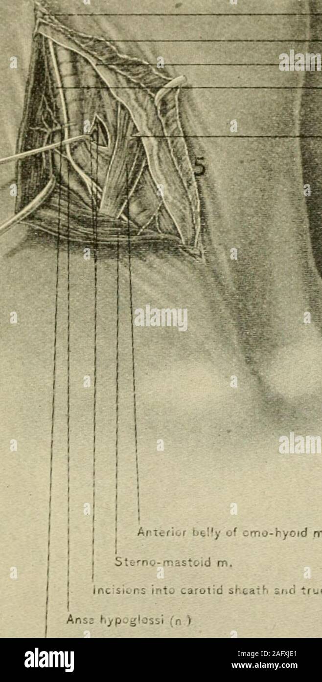 . Manuale di chirurgia operativa. e livello della cartilagine cricoid rendere athree pollici incisione orizzontale attraverso la pelle e platysma. Il incisionfollows la direzione delle pieghe nel collo e è leggermente obliquo abovedownwards da e verso l'interno (Fig. 997). Il centro dell'incisione deve corrispondere al bordo anteriore dell'sterno-mastoide. Dividere lo scudo che copre il mastoide sterno. Ritrarre il edgesof ferita. Carotide comune 837 passo 2.-retrarre il sterno-mastoide verso l'esterno. Riconoscere la anteriorbelly dell'omo-hyoid. Palpare per il tubercolo carotideo (processo trasversale,sesta cervica Foto Stock