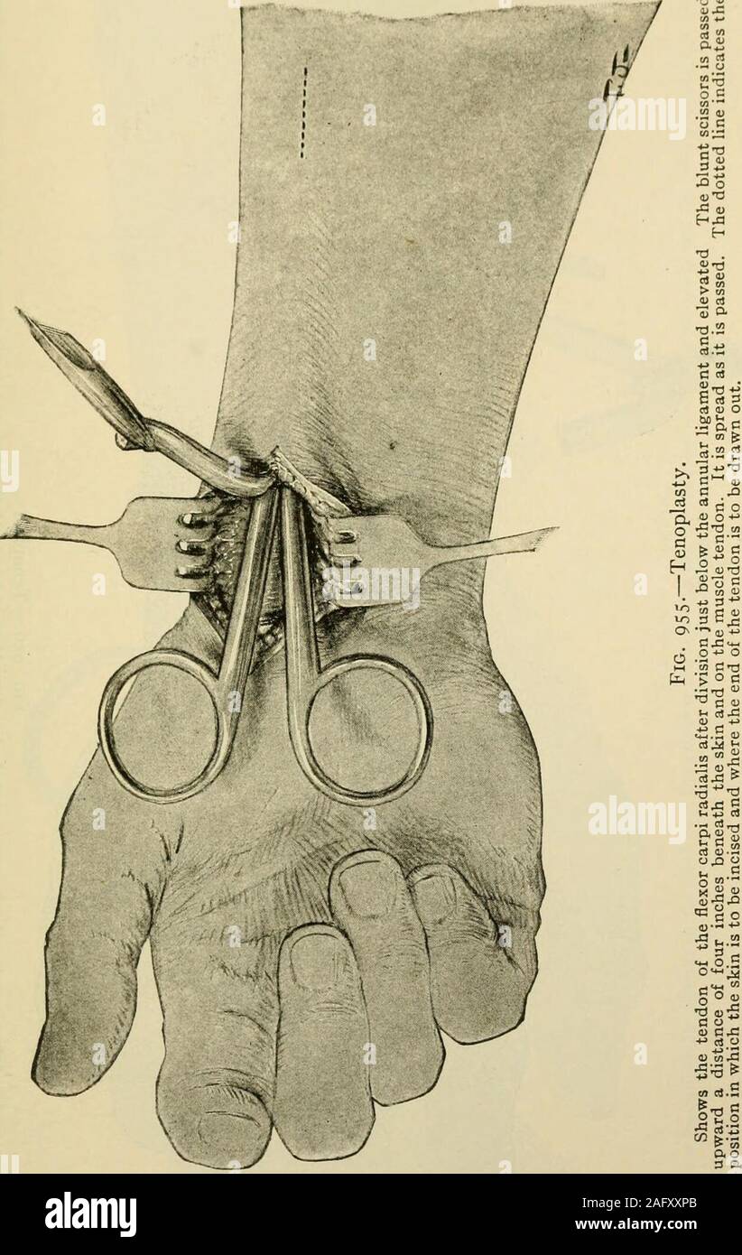 . Manuale di chirurgia operativa. la conduzione sembra troppo difficultor impossibili in tali circostanze il trapianto del tendine può restorefunction. A livello internazionale il Congresso chirurgico nel 1914, J. B. Murphy exhibiteda paziente che aveva subito gli effetti della divisione del muscolo-spiralnerve. Murphy per effettuare la dimostrazione più lampante gestito la trutha poco incautamente che descrivono il trattamento come se fosse stata la neurorrafia.Il risultato è stato accettato come eccellente. Egli ha poi confessato la scusabile piousfraud e spiegato che cosa realmente è stato fatto. Le Figg. 955, 956, 957,958 e 959, wit Foto Stock