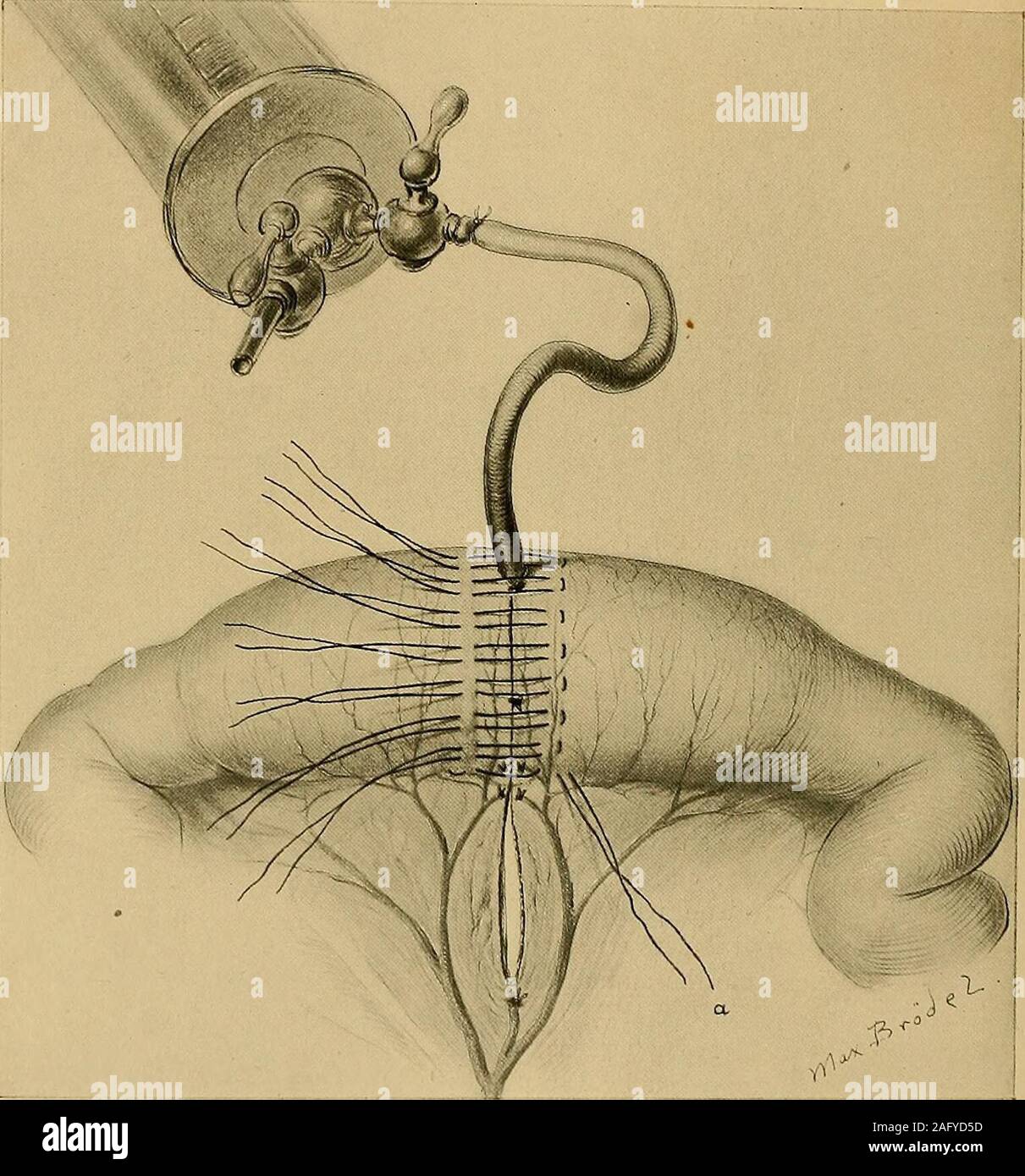 Operativa di ginecologia. Fig. 682.-l'MatteessSuture mesenterica ideato uy  Mitchell andHunker. Mostrare come esso viene fatto passare per fissare  ac-curato apposizione dell'intestino sul sidewliere l' Unione è più  difficile a ob-tain. Ogni