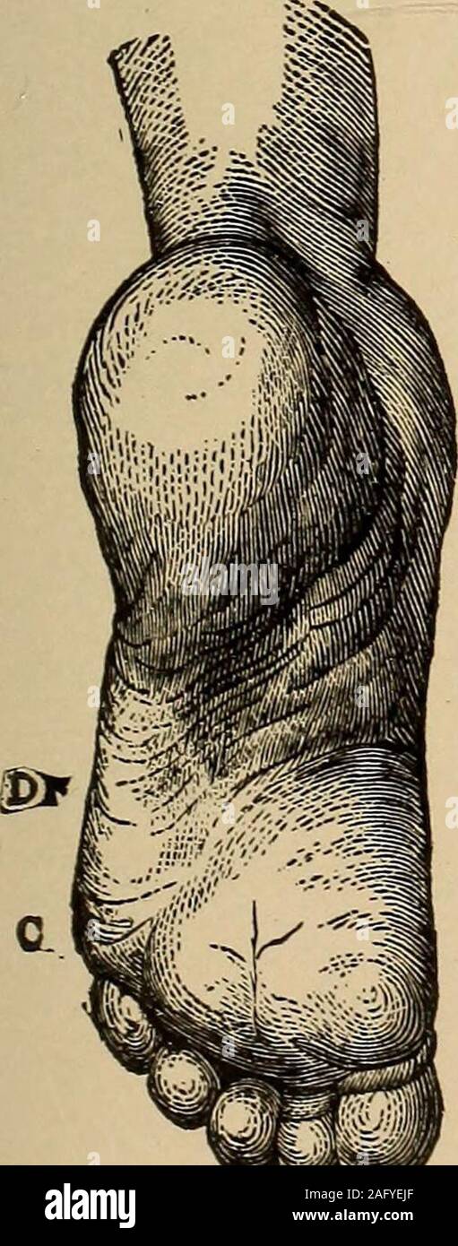 . Un trattato sulle malattie del sistema nervoso dei bambini, per i medici e gli studenti. FlG. 21.-Submetatarsal preminenza. ALower rispetto al normale e IncreasedPlantar Arch, risultante dal contratto-ura di Peroneus Longus. Fig. 22.-presentanti, in aggiunta, Promi-nence del tendine del PeroneusLongus F. (Duchenne.). Foto Stock