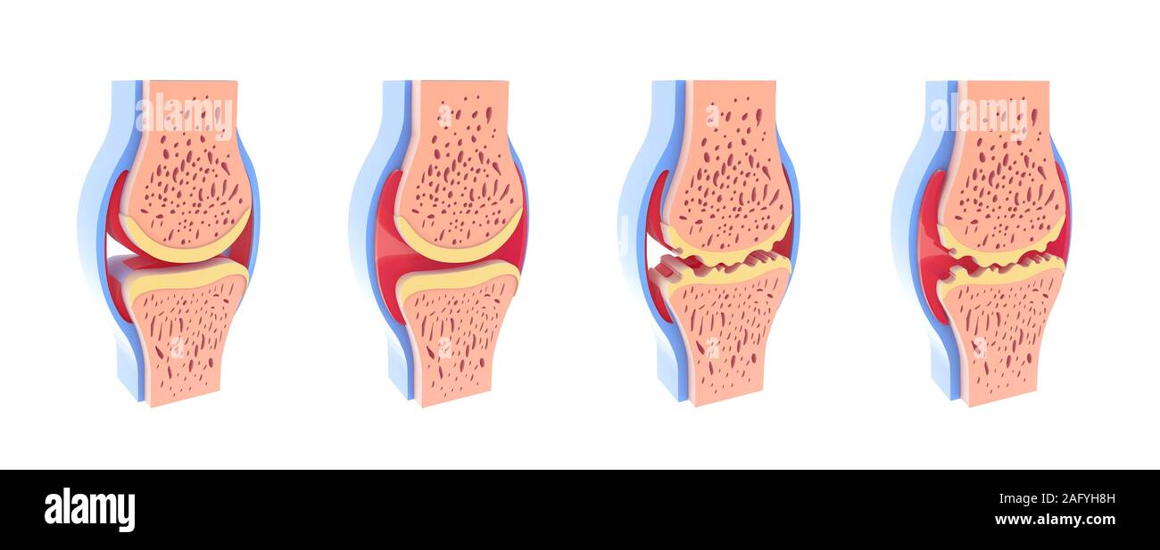 3d illustrazione di sani e sferica giunto sinoviale. In quattro rappresentazioni in piedi e isolato su sfondo bianco. Foto Stock