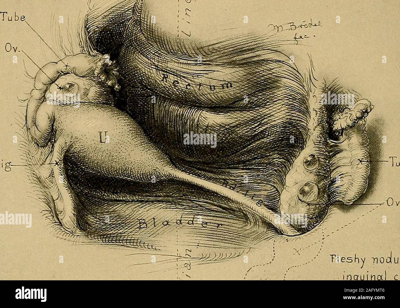 . Operativa di ginecologia. ed è diventato meno doloroso. Non va dimenticato che il omento e gli intestini possono anche enterinto la erniaria sac, e così tende a mascherare i sintomi derivanti dal pres-ence dell'ovaio. Diagnosi.-T egli la diagnosi di ernia dell'ovaio è facile in thej^resence dei segni caratteristici dettagliato e difficile in loro assenza. 488 La vulcanizzazione a radicale di ernia. Tlie storia mostra che il paziente ha avuto un piccolo grumo ovoidale in thegroin, può essere fin dall infanzia. Al momento della pubertà il grumo becomessuddenly dolorosa al ciclo mestruale, quando si gonfia a decidere Foto Stock