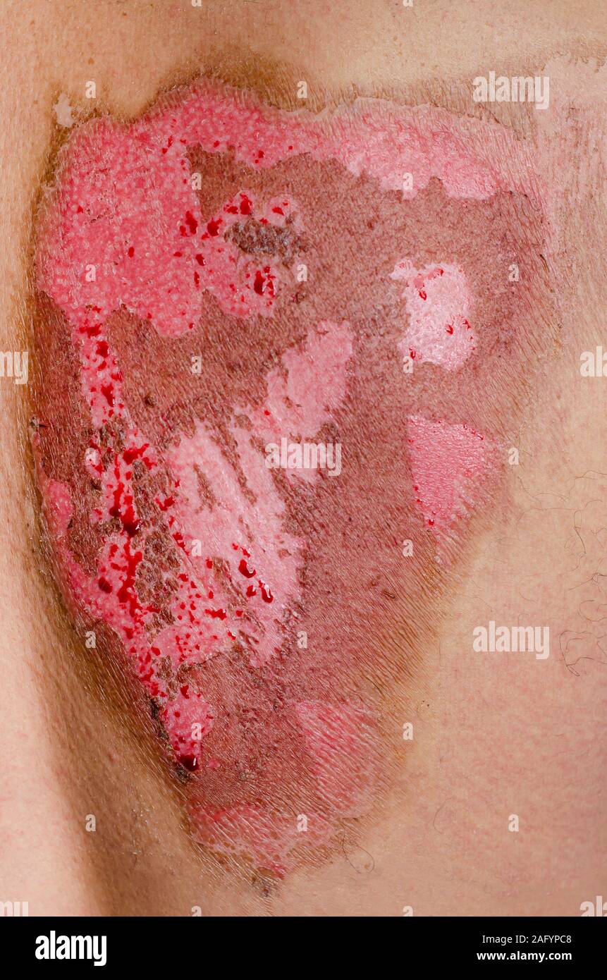 Immagine ravvicinata di un secondo grado di bruciare la pelle con emorragie causate dal calore. Foto Stock