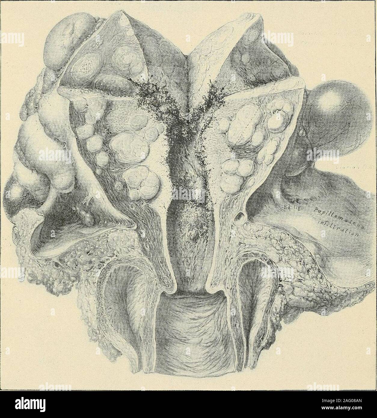 . La diagnosi e il trattamento delle malattie delle donne. t. Le caratteristiche di questi hanno alreadybeen dato. Vi possono essere in via eccezionale sia carcinoma e fibroide (Fig. 421). 2. Gravidanza addominale e Lithopedion (Figg. 422, 423, 424). 3. Tumori solidi di omento, intestino tenue o mesenterica. Questi usuallyappear vicino alla linea mediana e le indicazioni variano con la posizione. La diag-nosis poggia sulla presenza di una massa presentante i sintomi e segni tobe previsto in un tumore da una di queste strutture e per il quale non più-commondisease sarebbe account. Tali tumori sono solitamente accompagnati b Foto Stock