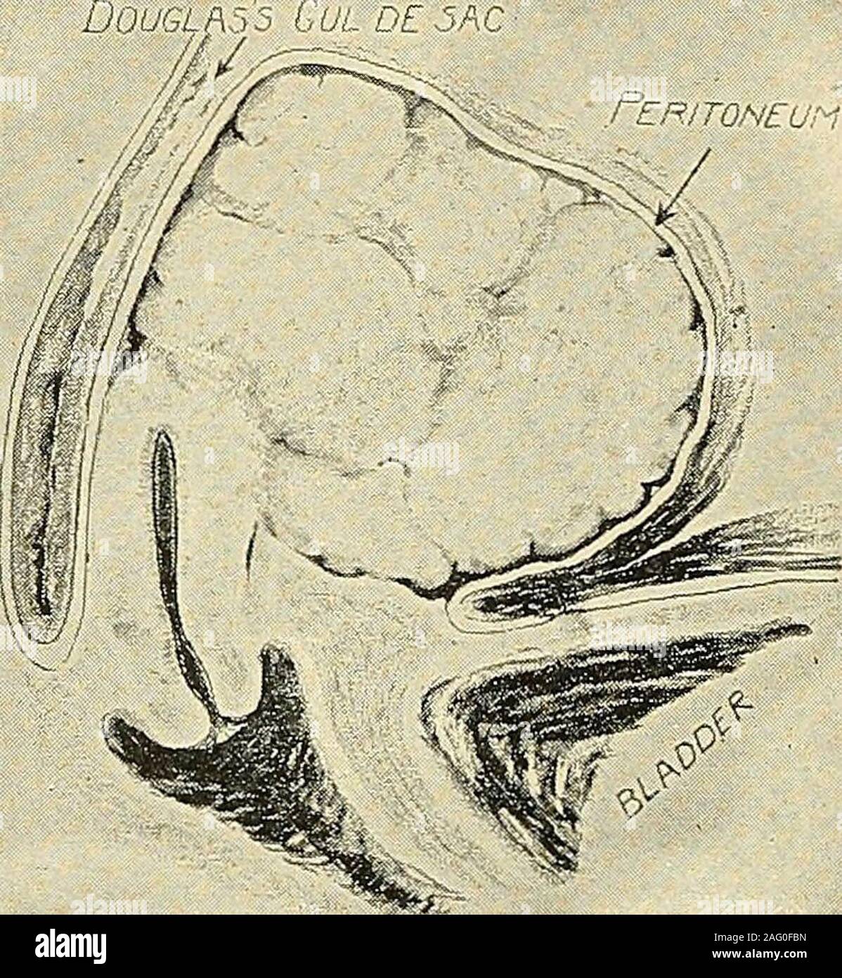 . La diagnosi e il trattamento delle malattie delle donne. leiomioma nella parete o di pus o sangue. 8. Piccole cisti di qualche struttura addominale giacente in cul-de-sac. Ad una ciste maycome dall'omento, del mesenterio o formare un rene prolapsed o milza. 9. Uretere notevolmente dilatato (idro-uretere o pyo-uretere) e riempimento nel retro del theuterus. • Messa bassa e nella parte anteriore della cervice.A. Massa o indurimento impresa. 1. Utero spostato in avanti. Ci può essere una qualsiasi delle solide condizioni di theuterus già menzionato. 2. Tumore fibroide di utero (Fig. 398). 3. La malattia maligna della cervice extendingforward o di t Foto Stock