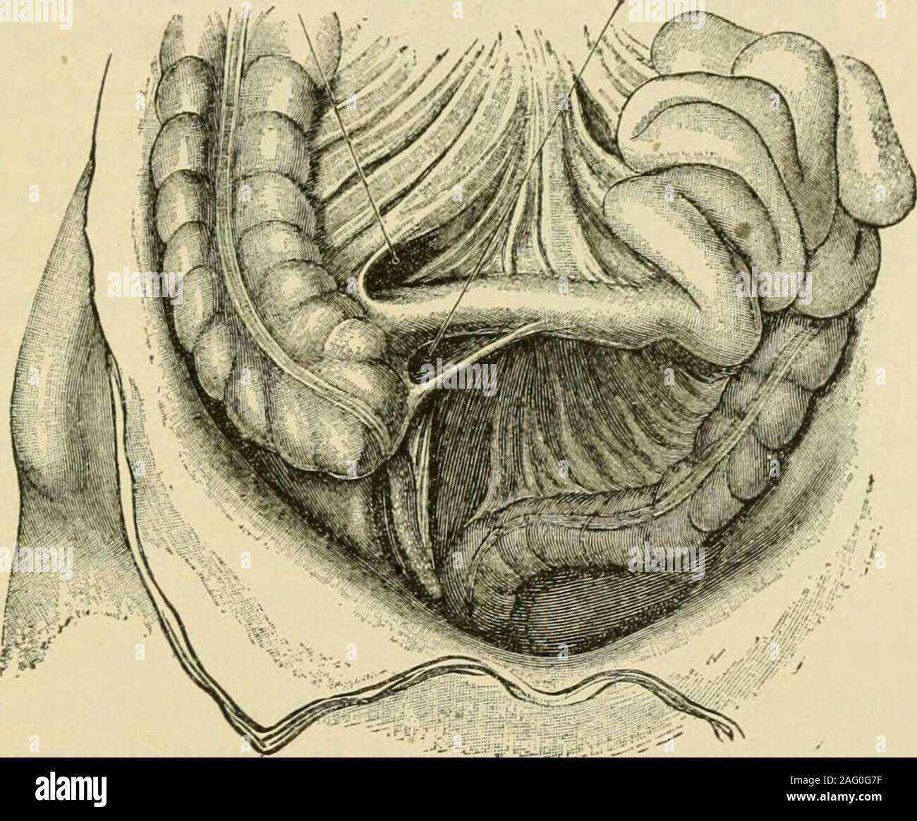 . Manuale di chirurgia operativa. ral varietà delle cavità in questa situazione,ma per i nostri scopi il riconoscimento della sua esistenza e della sua propensione a variare,sufficiente. Intestino può foro a modo suo nella cavità descritta, ingrandimento theopening e formando un retro-ernia peritoneale (Treitzs ernia). Il pouchformed dall'ernia gut può tendere a sinistra sotto il colonand discendente verso il basso per il bacino. Verso l'alto l'ernia può passare sotto la rootof il mesocolon trasversale in una posizione dietro lo stomaco e la milza.strangolamento è rara. Comunemente si suppone che il piccolo intestino da soli Foto Stock