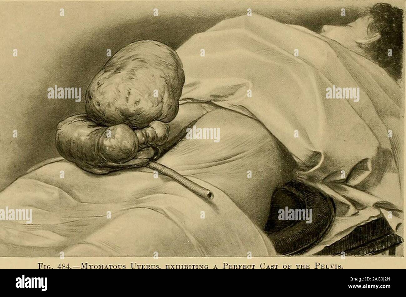 . Operativa di ginecologia. nnected con esso mediante un piccolo peduncolo solo, whilethey sono intimamente collegata alle pareti addominali, intestino, o omento.tumori con allegati omental presente più impressionanti caratteristiche di questo gruppo ; il omento costituisce una frangia intorno al bordo superiore della massa,e la sua congestionata e tortuoso vasi sanguigni vengono ingrandite per la dimensione di goosequills, cercando hke un cluster di cavi di frusta o di una collezione di angleworms in lospazio tra tumore e del colon trasverso. Forma peculiarità.-quando non trattenuto nella sua crescita un singlemyoma assumerà un più o meno s Foto Stock