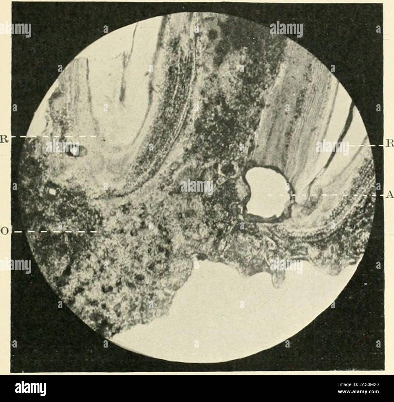 . La scienza e la pratica della chirurgia dentale. Fig. 551.-Aucliylosis. Sectiuii verticale uf la radi-cular porzione di un essere umano premolare aiichylosedto la ganascia. Preparato dalla decalcificazione, stainedwith hacmatoxylene. R, root o£ dente; B, l'osso della mascella. X 10. {Foto-grafico da il permesso di A. Hopewell-Smith.) ganascia; ma non vi è alcuna linea definitiva di demarcationbetween gli strati di tessuto, e nessuna traccia della membrana periodontale è quello di essere visto in area theaffected. Un grande numero di lacune, largein dimensioni e di forma irregolare, può essere visto sotto 497 tlie microscopio. I canalicoli variano in dimensionie nel disporre Foto Stock