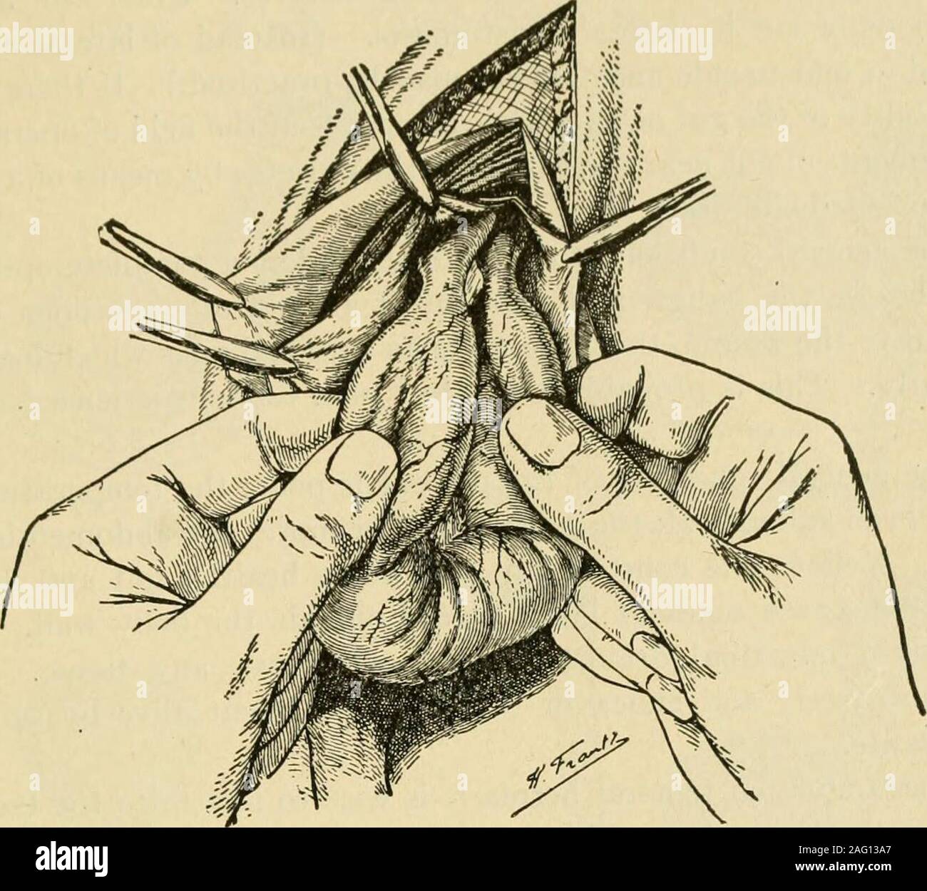 . Manuale di chirurgia operativa. infiammati o molto lacerato dalla divisione di adesioni più ofit dovrebbe essere rimosso. Questa operazione viene eseguita posizionando una catena di legature attraverso di esso(Fig. 718) e tagliare via la parte periferica a una distanza di almeno oneinch da legature. Rimuovere come piccolo omento come possibile; omento è il più prezioso. Dovrebbe essere gut pioderma, essa può essere trattata in vari modi: (a) Solo una piccola macchia sulla superficie libera dell'intestino è pioderma, Il restof il budello è sano. Invaginate il pioderma patch da pochi Lembertsutures (Fig. 719). Esaminare per vedere se il in Foto Stock