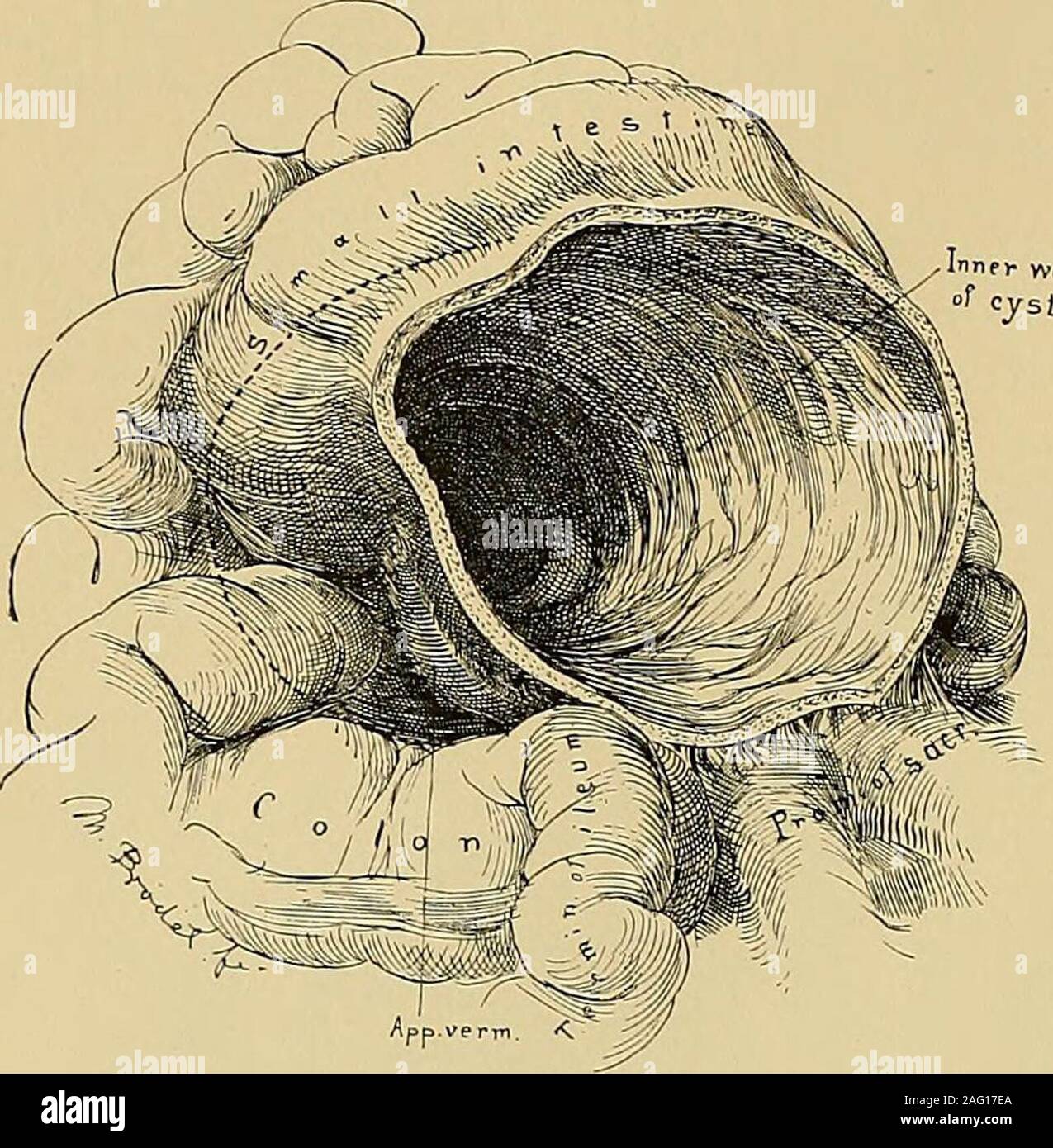 . Operativa di ginecologia. Fig. 440.-Suppurati mostra ampia allegati all'utero, vescica, omento, piccolo intestino, mesenterio e. Thebladder e l'utero viene tirata in alto al di fuori del bacino. Gen 20, 1897. capitolo sulle complicazioni comuni a operazioni addominale. Vorrei qui onlyinsist su alcune peculiarità connesse con questo gruppo di tumori. Il adhe-tanze alla parete addominale che talvolta prendere in tutta la sezione anteriore parietesmust essere staccata con la deliberata attenzione al fine di evitare la dissezione di spegnere il peritoneumwith ovariche sac. Un tale dissezione difettoso è di solito iniziato all'incis Foto Stock