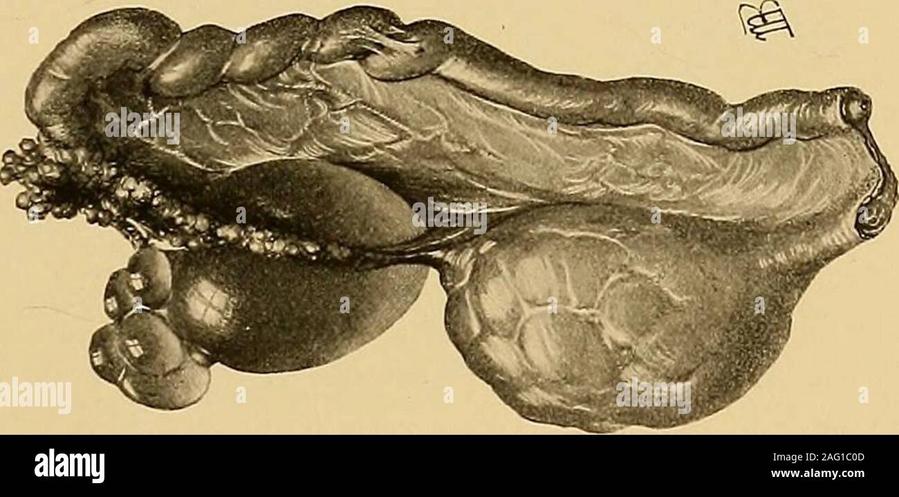 . Operativa di ginecologia. etworks sono visto che si incrociano. La ciste areusually pareti sottili e possono contenere piastre calcaree ; la superficie interna è biancastra orpinkish a colori, lisci e luccicante ; raramente masse papillare molla dalla parete theinner. La ciste fluido, poveri in allnnnin, è chiaro e limpido come l'acqua, edella sua gravità specifica varia da 1001 a 1006. In tali casi tuttavia, wherethere sono masse papillare, o in cui emorragia ha avuto luogo nella cisti,la gravità specifica è maggiore e il colore marrone, nerastro o giallo. Orthsays che ha quasi invariabilmente stato ab Foto Stock