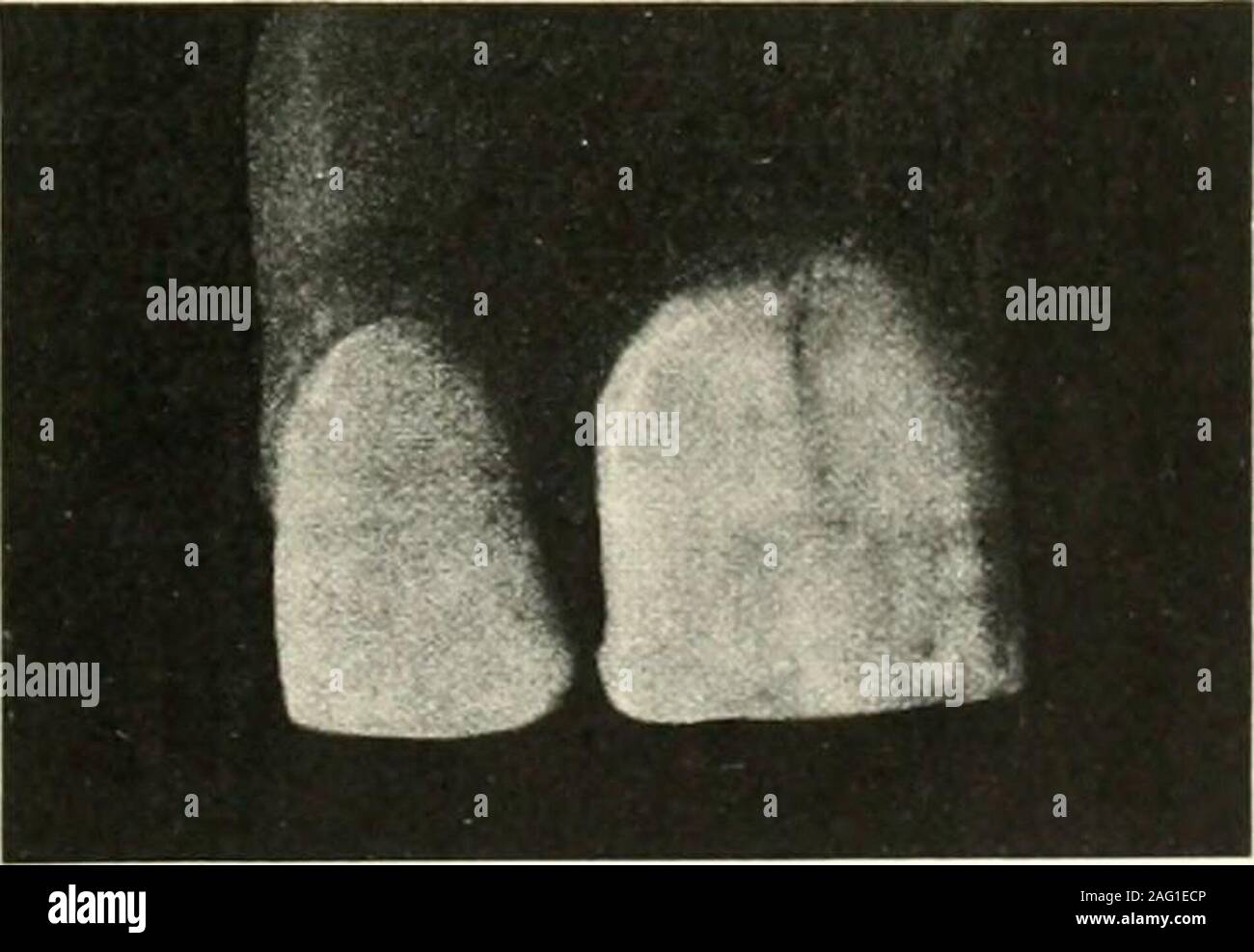 . La scienza e la pratica della chirurgia dentale. Fig. 45J. del riempimento; mentre il giunto è quindi coveredgingival reiterazione di carie non avrà luogo.La manutenzione dell'inter-spaceand prossimale della salute dei tessuti che lo occupa aretherefore di prima importanza nel preven-zione di carie e pyorrhoea alveolaris.. Fig. 451. Lo studente è consigliato di nota bene tlie formof le linee gengivale su gli incisivi come seenin queste figure, in modo che nell'applicazione ofligatures, strumenti di finitura, ecc, egli maythe una migliore protezione contro la violenza alla peri-cemento che, se Foto Stock