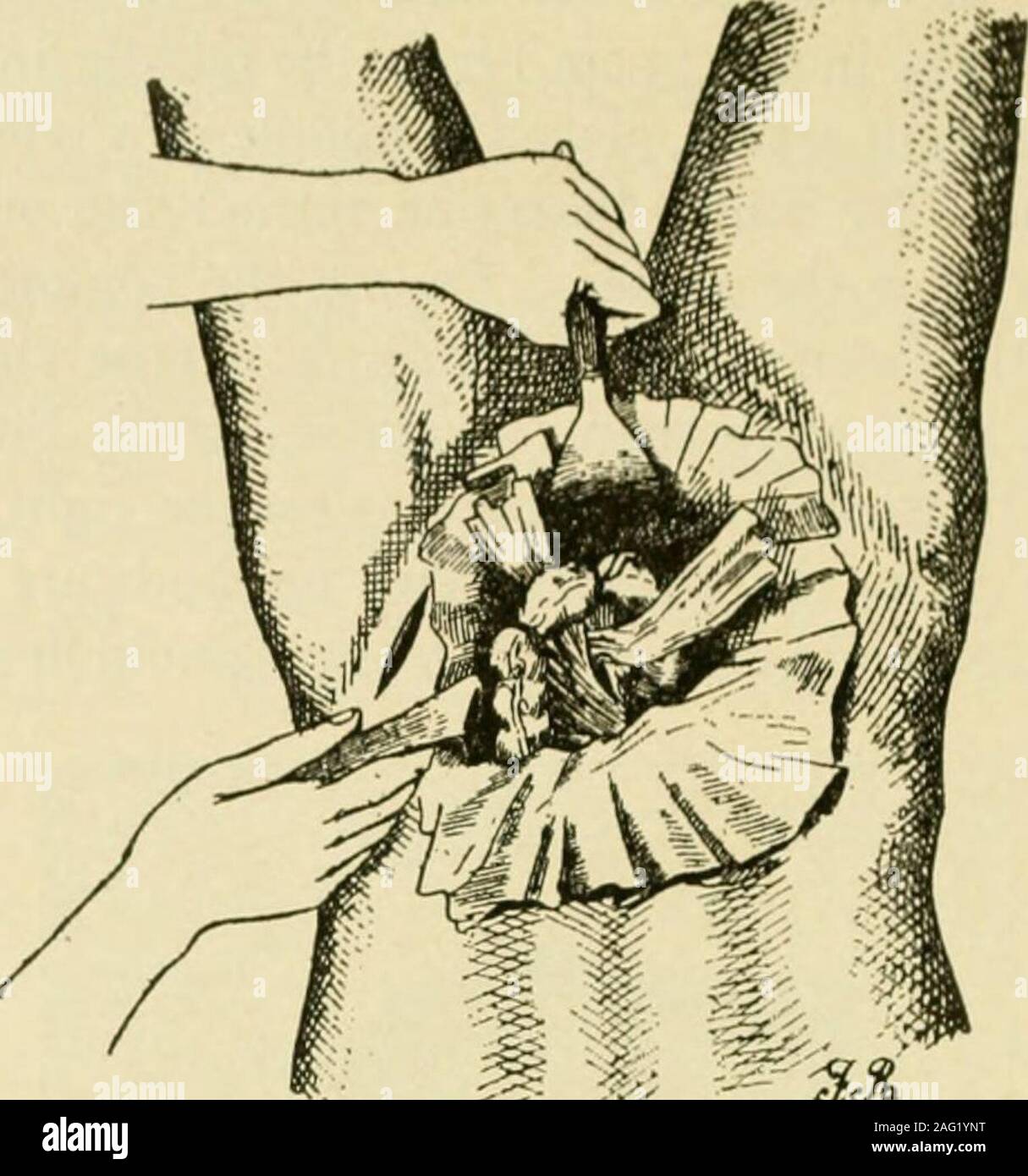 . Manuale di chirurgia operativa. iliaca che sarà difficile, è più semplice per mettere questa fase off untilafter sigmoide è stato diviso e il campo di funzionamento è stata madeeasier di accesso. Mentre i vasi iliaci sono esposti, esaminare questa regione forenlarged ghiandole linfatiche. Chiudere le ferite realizzata nel peritoneo oltre thearteries. Passo 3.-In un punto libero da vasi sanguigni strappare un foro nel meso-sigmoidand passa una larga striscia di garza attraverso di esso (Fig. 648). Proteggere il abdominalcavity con tamponi di garza. Con le dita svuotare il contenuto da che la partedell sigmoide di fronte alla lacerazione nel Foto Stock