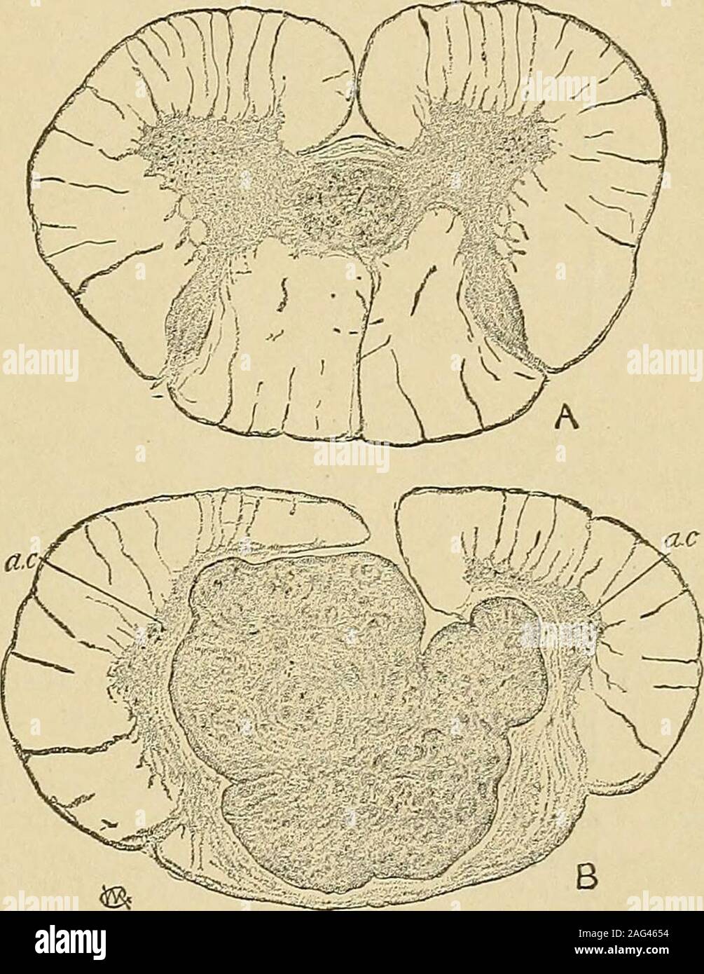 . Un manuale di malattie del sistema nervoso. è frequentemente increasedby ammorbidimento nell'vicinityof la crescita. Se il tumorreaches la superficie il piamater e arachnoid può bethickened alla macchia, andthey può anche essere adherentto la dura madre, ma raramente thereis qualsiasi estensione di themeningitis ad altre parti.Nella sezione la crescita isusually veiy distinti, sinceits contrasta withthat del nervo-sostanza.Solo glioma e myxomaresemble il normale graysubstance in apparenza, butthe nuovo tessuto usuallydistinct è in posizione. Thesetumors in alcuni casi blendwith la sostanza di thecord Foto Stock