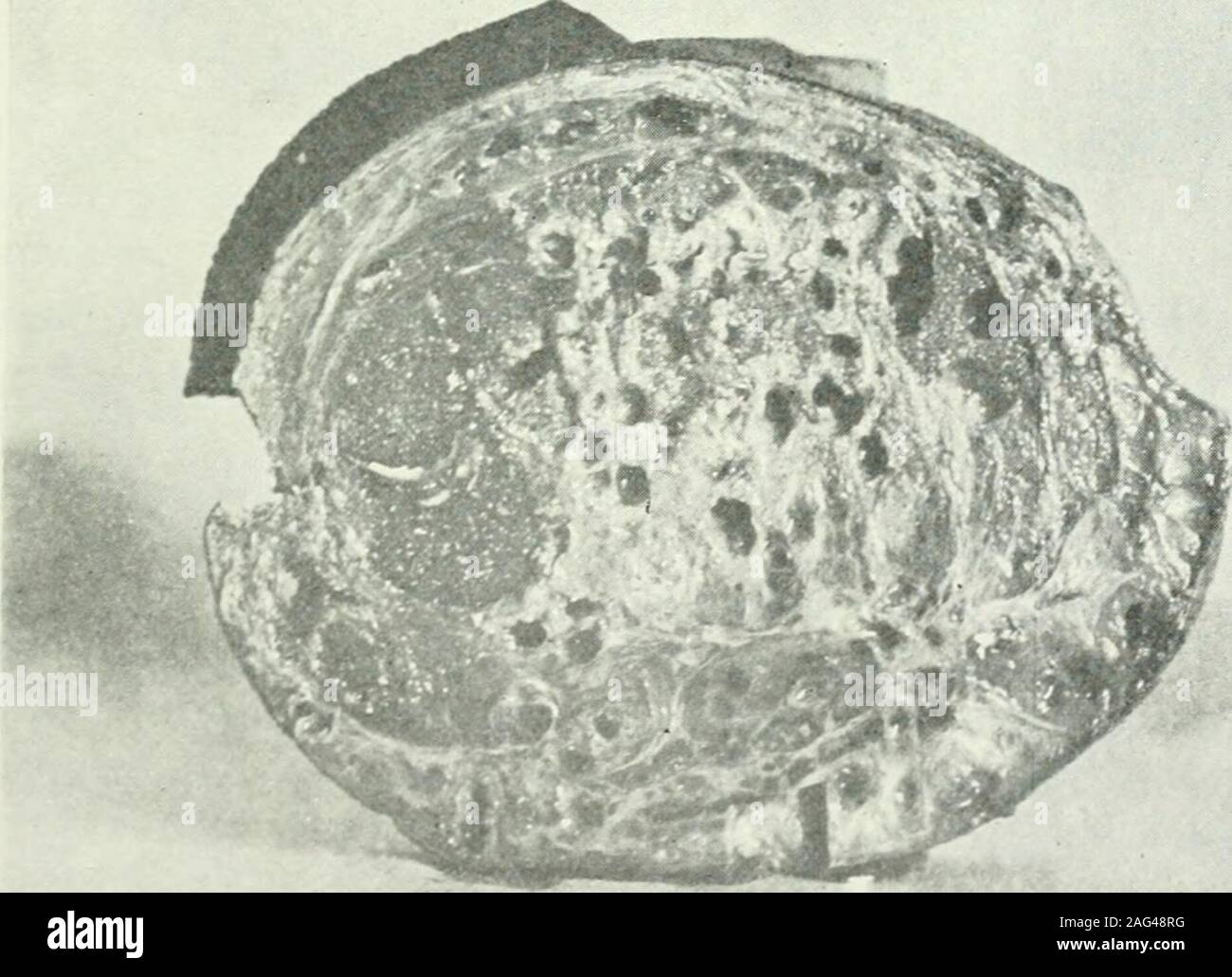 . Il giornale americano di medicina tropicale. h Fig. 3. Piedi del caso 27 (Singleton). Fig. 4. Trasferire file.se la sezione del piede del caso 27 244 MARK F. BOYD E EARL D. CRUTCHFIELD gether scomparso. Le ossa per la maggior parte non sono state de-stroj^ed e di tutti i tessuti sono stati meno alterato. Il quinto metatar-sal ha subito una marcata rarefjdng e il proliferare di osteite. Thestriking caratteristica dell'interno sono le numerose e oltremodo irregularsinuses che perforano i tessuti in ogni direzione, ma sono mostabundant sotto la volta ossea. Essi variano in diametro da 1 a 6mm. e può giacere s Foto Stock