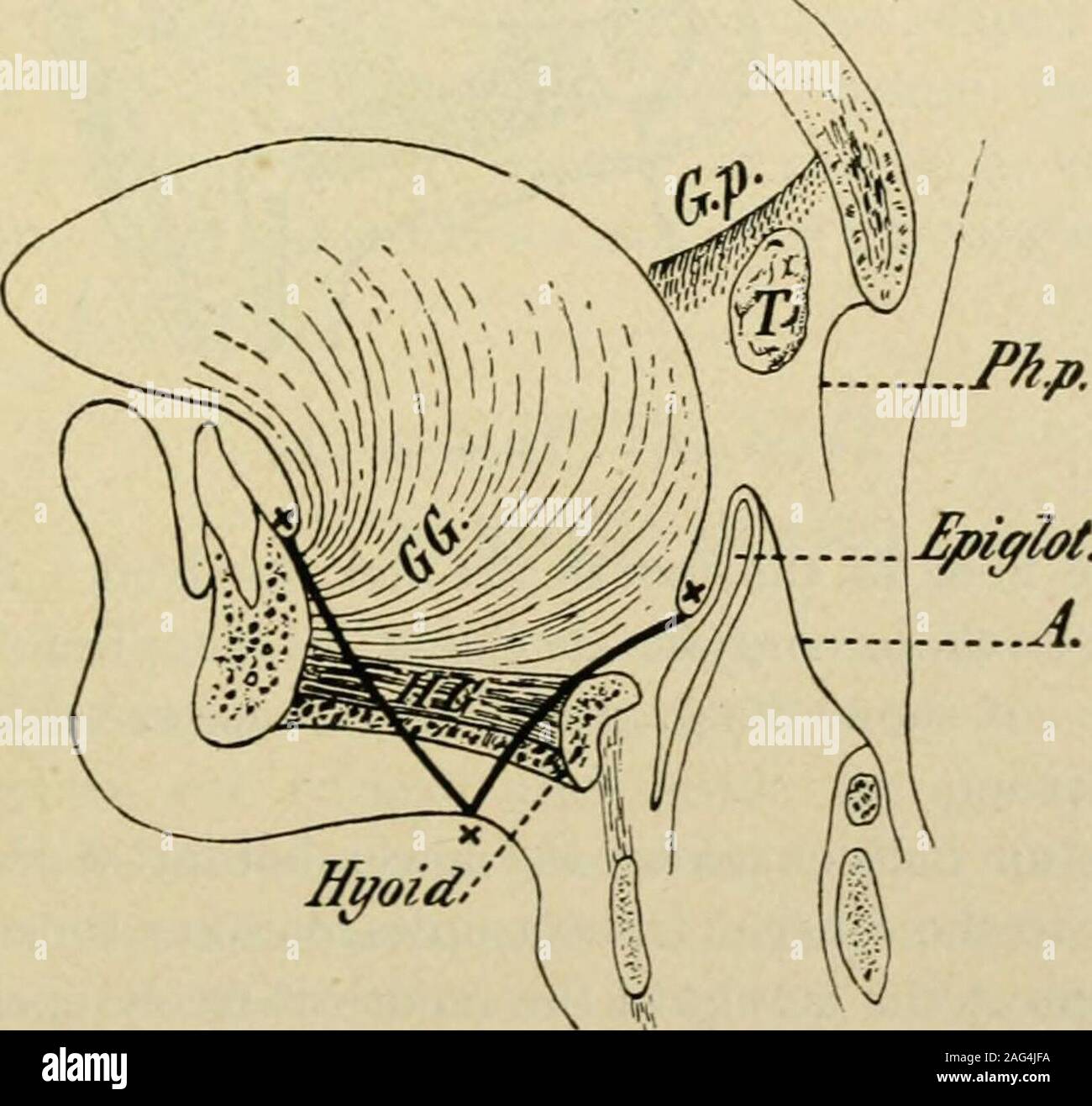 . Manuale di intervento chirurgico. Fig. 266.-Dopo la rimozione della linguetta, il pavimento della bocca è coperta parzialmente mediante sutura mucosaof guancia attraverso alveolo al moncone della linguetta. Un emostatico è sulla destra arteria linguale in thefloor della bocca. {Ashhurst, Annali di Chirurgia.). Fig. 267. 172 linguetta adatto anche per la rimozione di corpi estranei ed il trattamento di sj^ihiHticstrictures. Una tracheotomia preliminare non è essenziale. L'operazione. La fase i.-fare una incisione mediana attraverso la pelle andsubcutaneous tessuto da sinfisi della ganascia inferiore al superiore inclinazionedi la cartilagine della tiroide. Passo 2.-Con Foto Stock