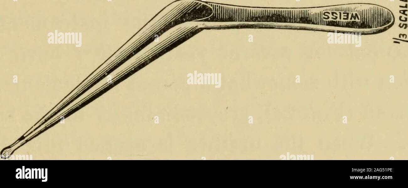 . Clinica stenosi dell'uretra e allargamento della prostata. Fig. 22. bordi della ferita sono tenute a riposo da catch-forcipe, o da aloop di seta trasferito su entrambi i lati mediante i margini di theurethra. Il becco del personale viene quindi girata andhooks fino all'estremità superiore della incisione. Tutti lo spurgo havingbeen arrestato e la ferita sponged attentamente il volto della stenosi entra in vista, e l'apertura è cercata,. Fig. 23. e quando si trova una piccola sonda-direttore sagomato (Fig. 22) vienespinta attraverso nella vescica. La stenosi è tagliata su itslower aspetto passando alo Foto Stock