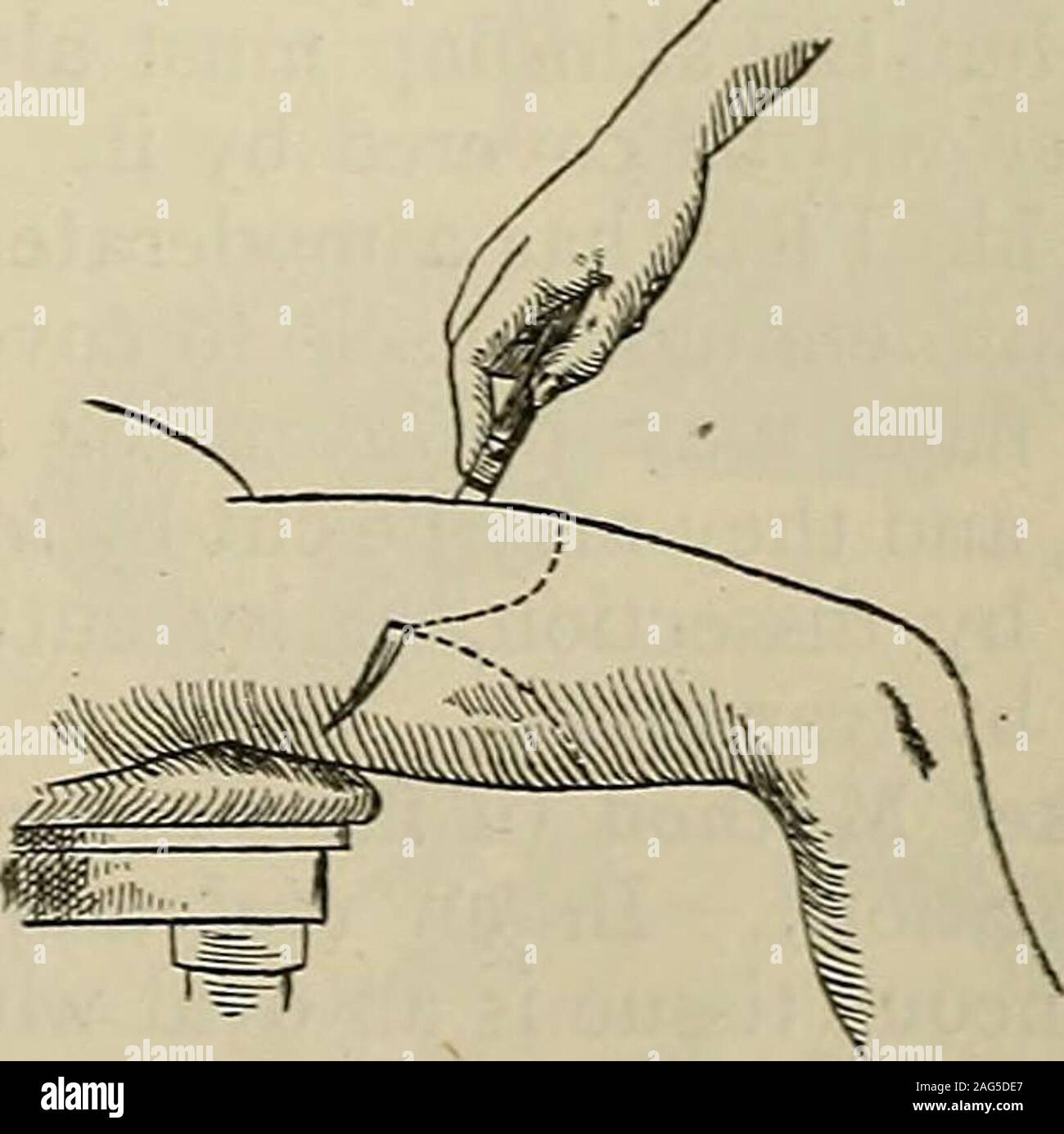 . La moderna chirurgia generale e operativa. Fig. 1039.Figg. 1037-1039.-l'Earl}- passi di un Fig. 1040.-l'amputazione della coscia da trans-obliquo amputazione circolare (Kocher). fixion (lordo). lato di estremità rispetto all'altra, la trasversale di incisione circolare sac-rifices più dell'arto rispetto a ciò che è necessario e il obhque circolare è pref-98 1^54 recisioni erable. Un'obiezione lo trasversale di incisione circolare è che la cicatrixlies direttamente alla fine del moncone ed è suscettibile di causare dolore quando subjectedto pressione. Lavare il metodo circolare.-la pelle e fascia superficiale sono divisi Foto Stock