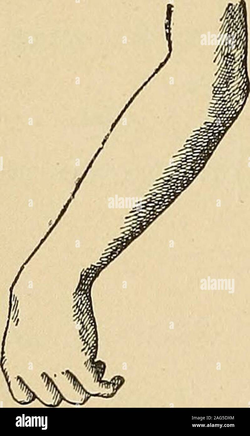 . Un manuale di malattie del sistema nervoso. estensore del metacarpalbone del pollice, come può essere notato se il dito viene collocato sul tendine beneaththe styloid processo dell'ulna. Quindi, in una paralisi della presente estensore, il handdeviates lateralmente quando il pollice è fortemente esteso. Extensors delle dita.-estensore communis digitorum; E. indicis ;E. minimi digiti (muscolo-spirale nervo-C. 6 e 7). Il comune extensormoves le dita e poi il polso. Quando il muscolo è faradised, theextension inizia a falangi distali e questi diventano flessa nuovamente, quandola parte è esteso al di là di Foto Stock