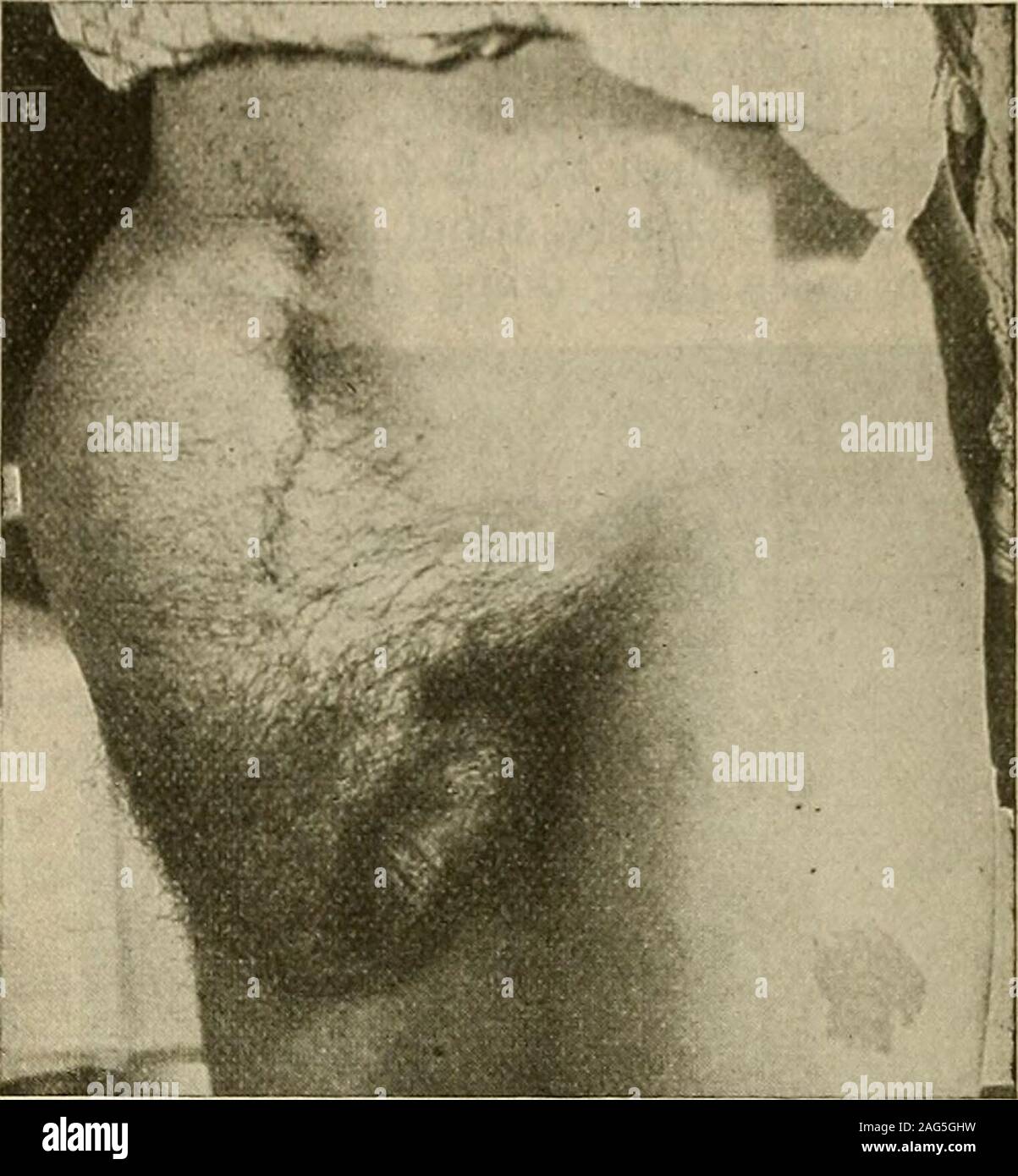 . La moderna chirurgia generale e operativa. senza provisionfor drenaggio. Un buono piano è toincise sac, asciugare il suo interno bybits di garza, tampone fuori withpure acido carbolico, questo pack withiodoform garza e abito anti-septically. Il confezionamento viene nuovamente spostato in ventiquattro ore eil ferita è consentito di chiudere. Intimo casi io preferisco questo metodo.Se il codice degli aiuti alla siderurgia è rigido e non col-lapse, né la maglia al pacco skinand esso o le accise un gran partedell il suo strato parietale e inserire adrainage-tubo {Volkmanns oper-zione). Un altro progetto è toccare thesac con un trequarti e cannula, leav-ing CAN Foto Stock