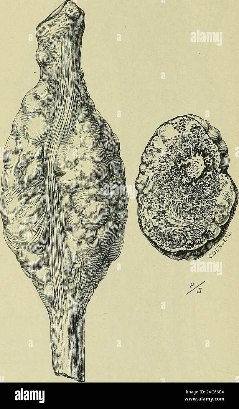 . Tumori, innocente e patologie maligne; i loro caratteri clinici e un trattamento adeguato. Nodulo Accessary ofsarcoma. Membrana Interosseous. - Sarcoma. Longus flessore liallucis. Peroneus longus. - Porzione distaccata di theflexor longus liallucis Fig. 49.-mandrino-celled sarcoma del perone. {Museum, Middlesex Hospital.) eseguire ad un rapido corso come nel femore. Per esempio, abbia avuto la possibilità di seguenti nove casi di sarcomaof il fenmr durante tutto il loro decorso clinico. Tuttele pazienti sono morti entro un anno di funzionamento da dissemi-nazione del tumore o dalla ricorrenza locale. In Foto Stock