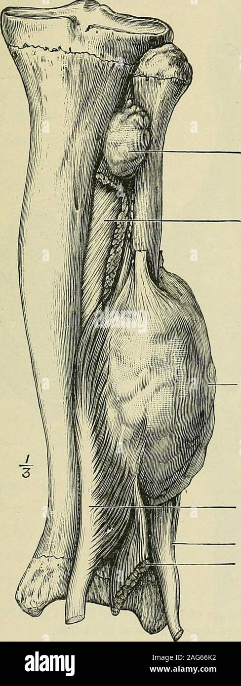 . Tumori, innocente e patologie maligne; i loro caratteri clinici e un trattamento adeguato. /3i-T7£/-y"|TH-[C Fig. 48. -Tibia e perone. La tibia è notevolmente ampliato per tutta la sua lunghezza da un sarcoma acentral. Da un uomo di 24 anni di età. {Museum, Royal College of Surgeons.) 8JBC0MAS DI OSSA 83 febbraio egli è stato soffocato da grandi noduli secondario ofsarcoma comprimendo i bronchi. La tibia.--sarcomi sono abbastanza comune in questo osso;preferiscono la tomaia alla estremità inferiore e non. Nodulo Accessary ofsarcoma. Membrana Interosseous. - Sarcoma. Longus flessore liallucis. Peroneus longus. - De Foto Stock