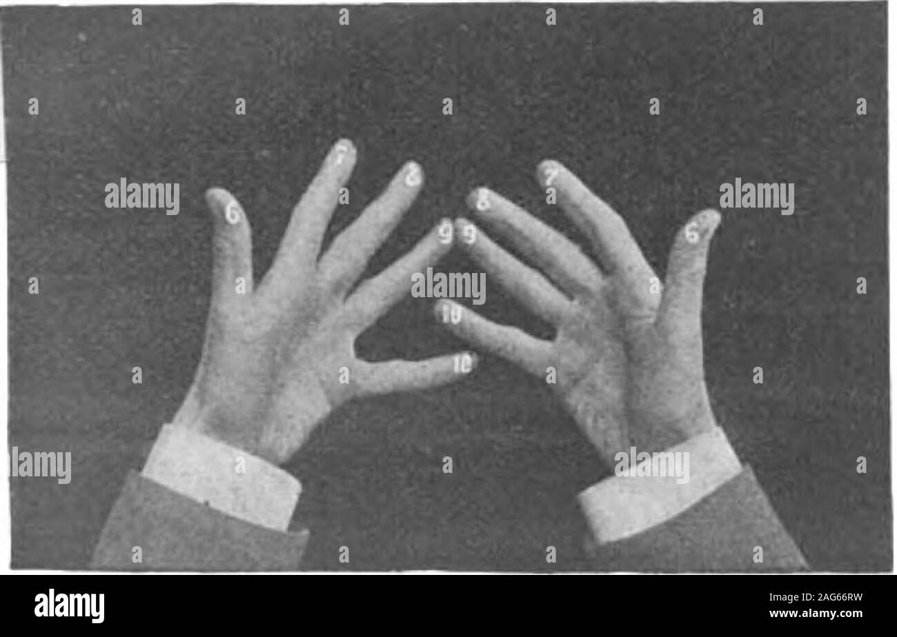 . Scientific American Volume 79 Numero 17 (ottobre 1898). ningon un lato, moltiplicato per quelli lasciati sul otherhand, darà il numero di unità che, essendo add-ed a decine, fornisce il prodotto desiderato. Per l'esame-ple : Supponiamo che 8 deve essere moltiplicato per 9. Il mid-dle dito della mano destra è posizionato contro il dito anulare della mano sinistra, come mostrato nel maiale. 2. Countingthe numero di dita al di sopra di quelli che hanno beenplaced insieme, compresi questi sette dita, offrono-senting 7 decine o 70 nel prodotto cercato, sono ottenuti.rimangono ancora sulla destra due dita, whi Foto Stock